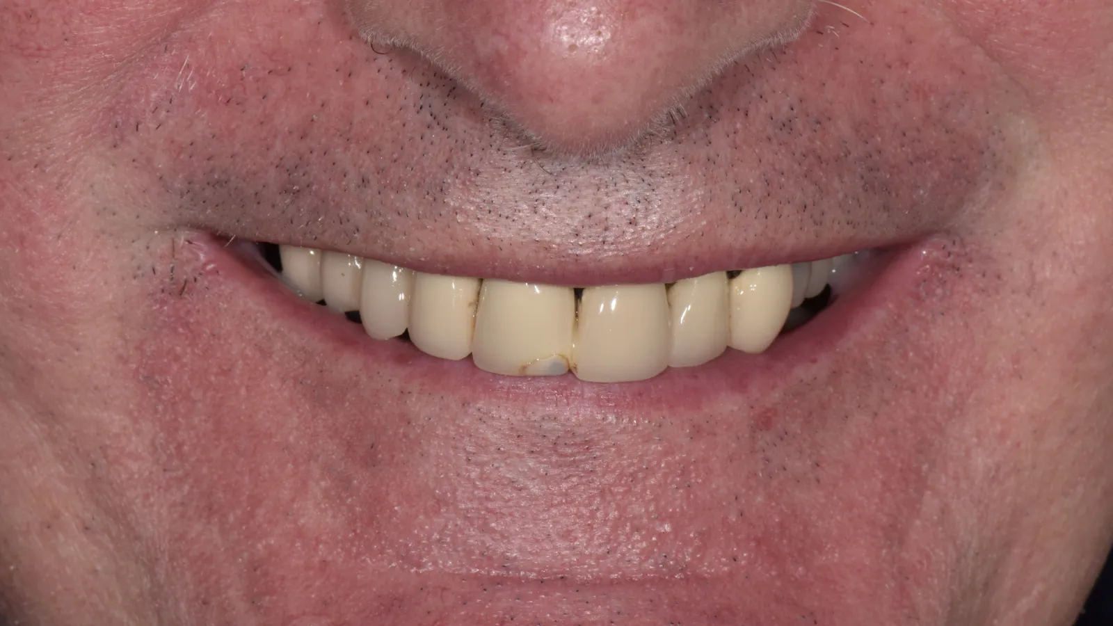 Close-up of a man's smile showing stained and chipped dental veneers on front teeth.