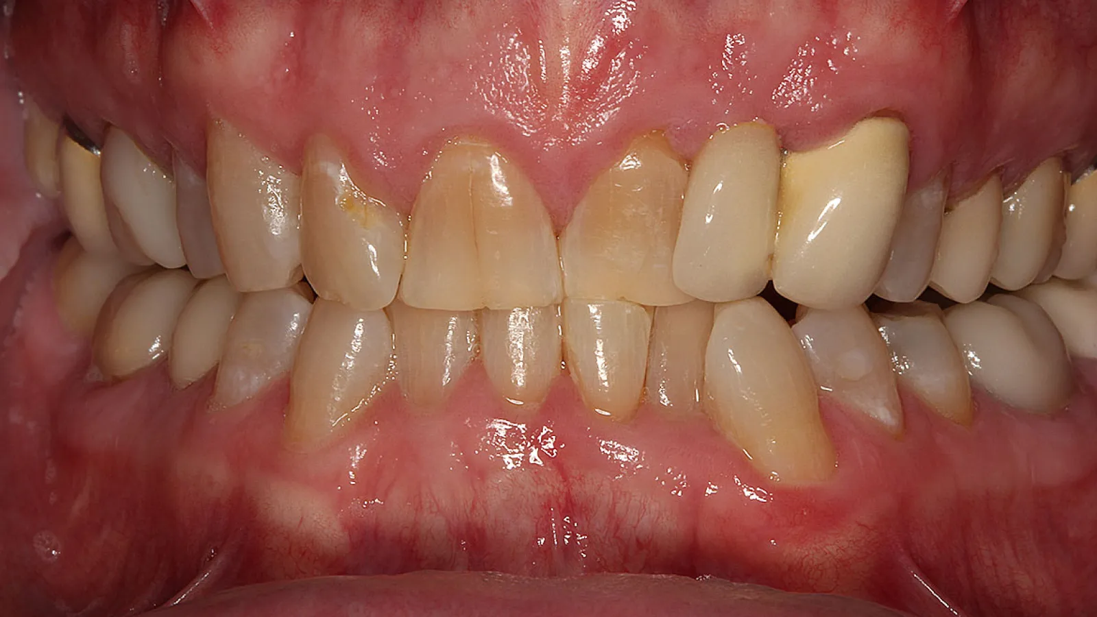 Close-up of stained, misaligned adult teeth with visible plaque and red gums indicating dental issues.