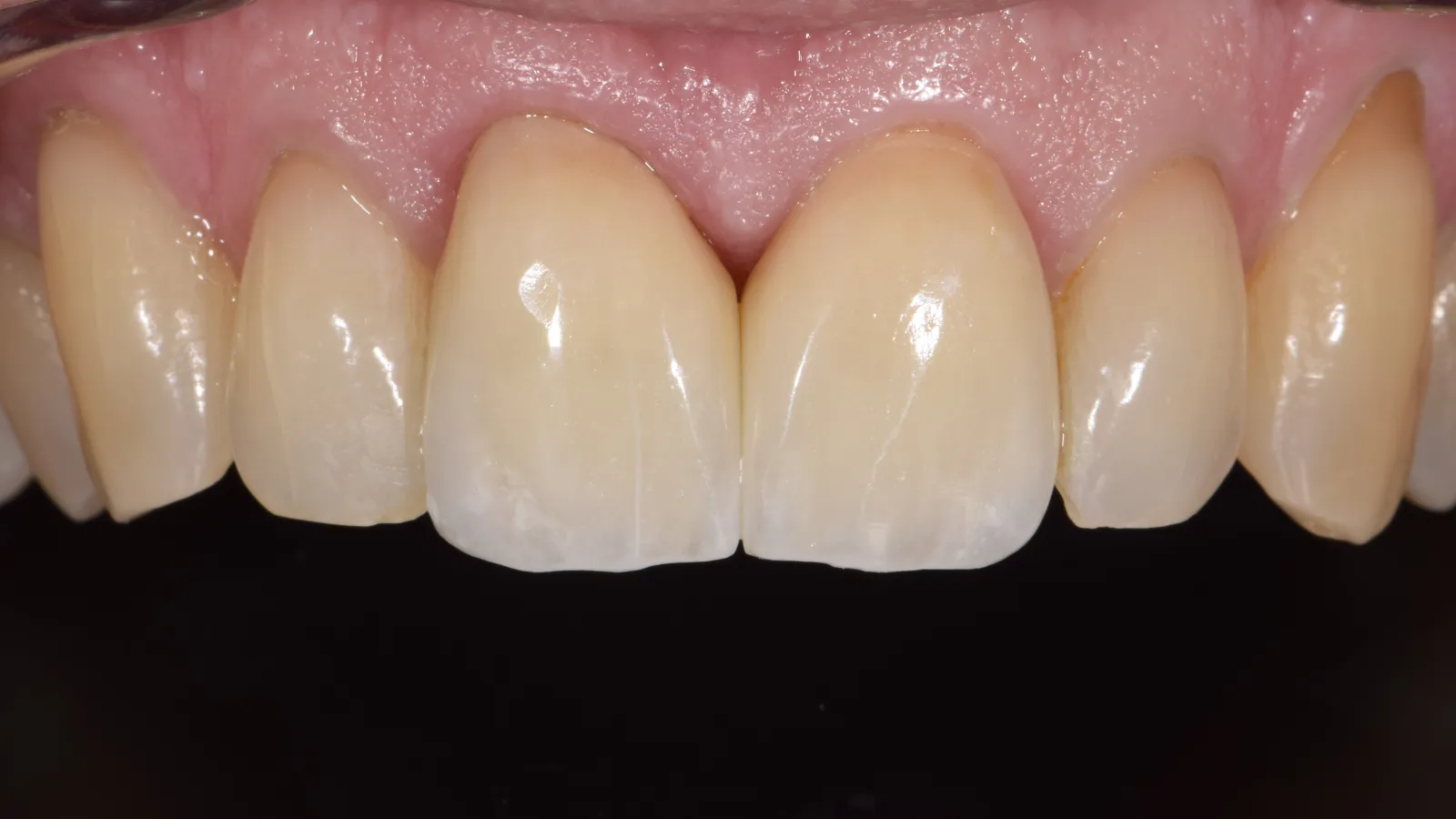 Close-up of upper front teeth with healthy gums and natural enamel texture.