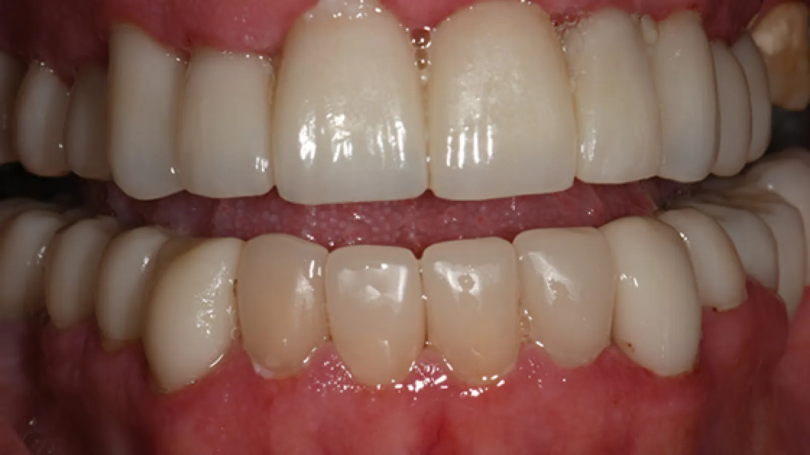Close-up of natural upper and lower teeth with healthy pink gums and slight tooth color variation.