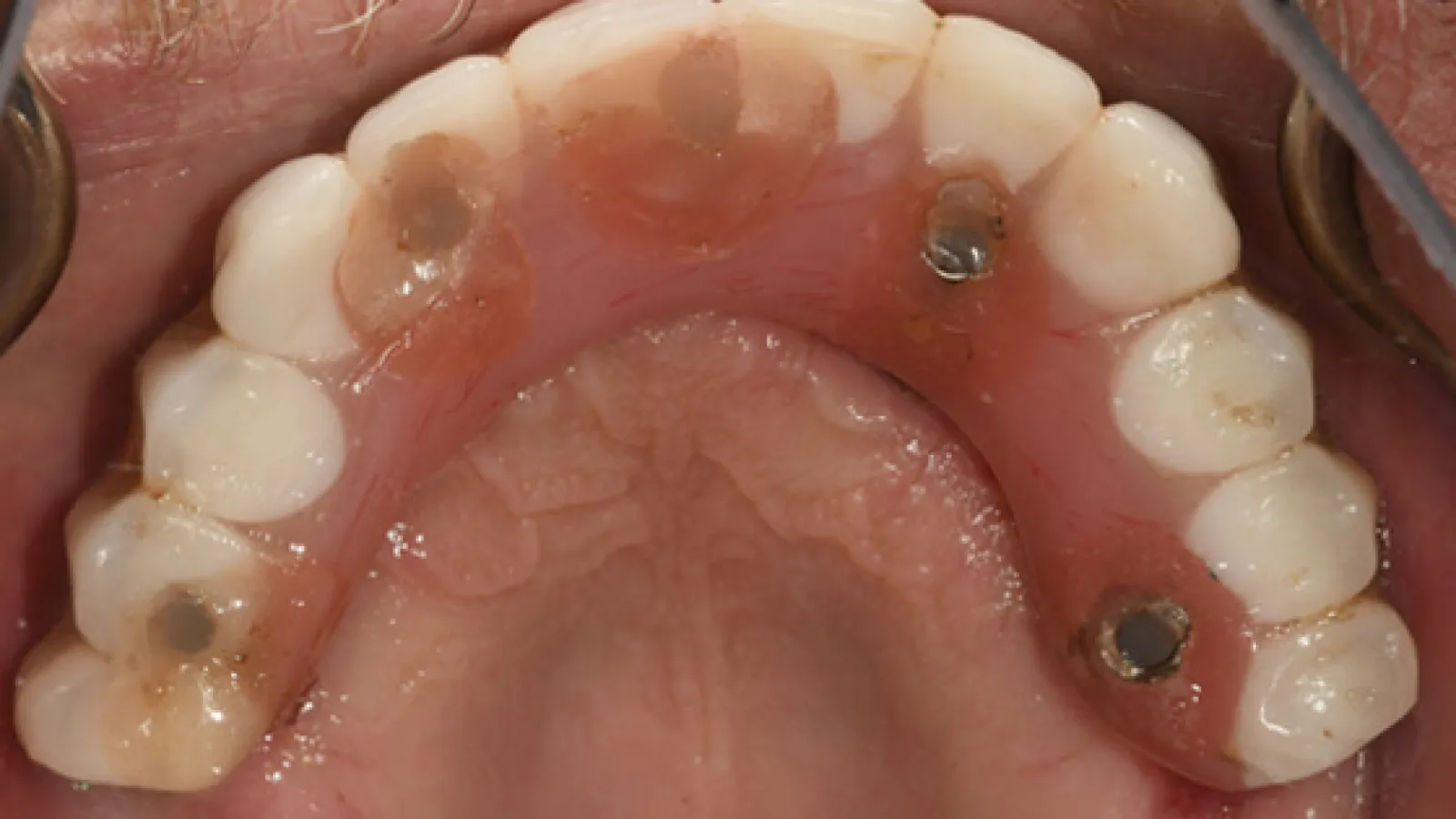 Close-up of upper teeth with multiple cavities and dental decay visible on several molars and incisors.