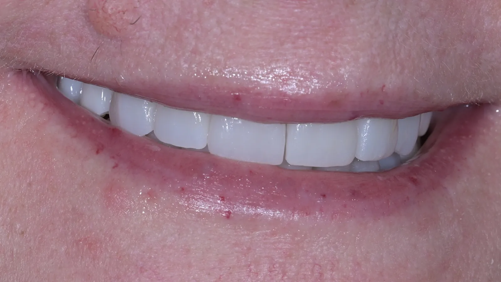 Close-up of a smiling mouth showing clean white teeth and slightly dry lips with minor blemishes.