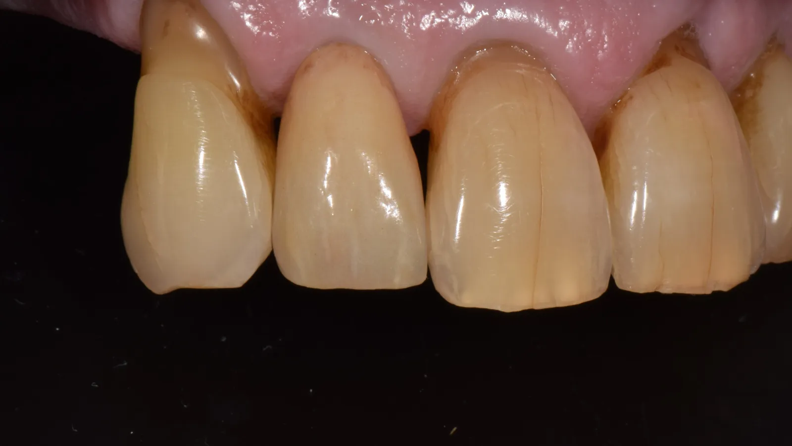 Close-up of stained and discolored upper front teeth with visible tartar buildup and gum inflammation.