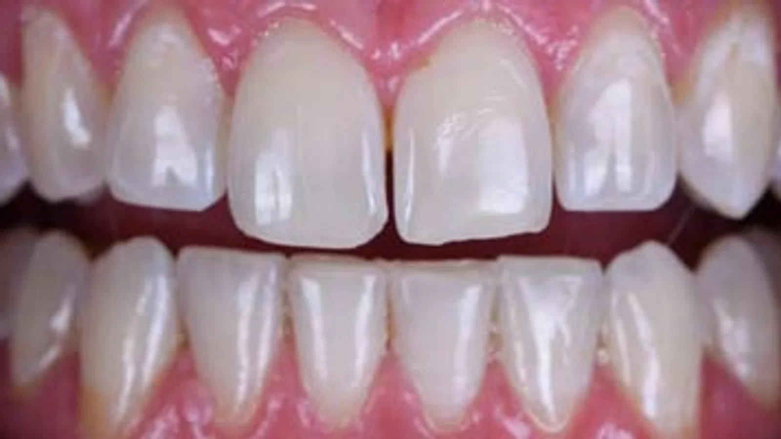 Close-up of clean, healthy white teeth with pink gums and slight gap between upper front teeth.