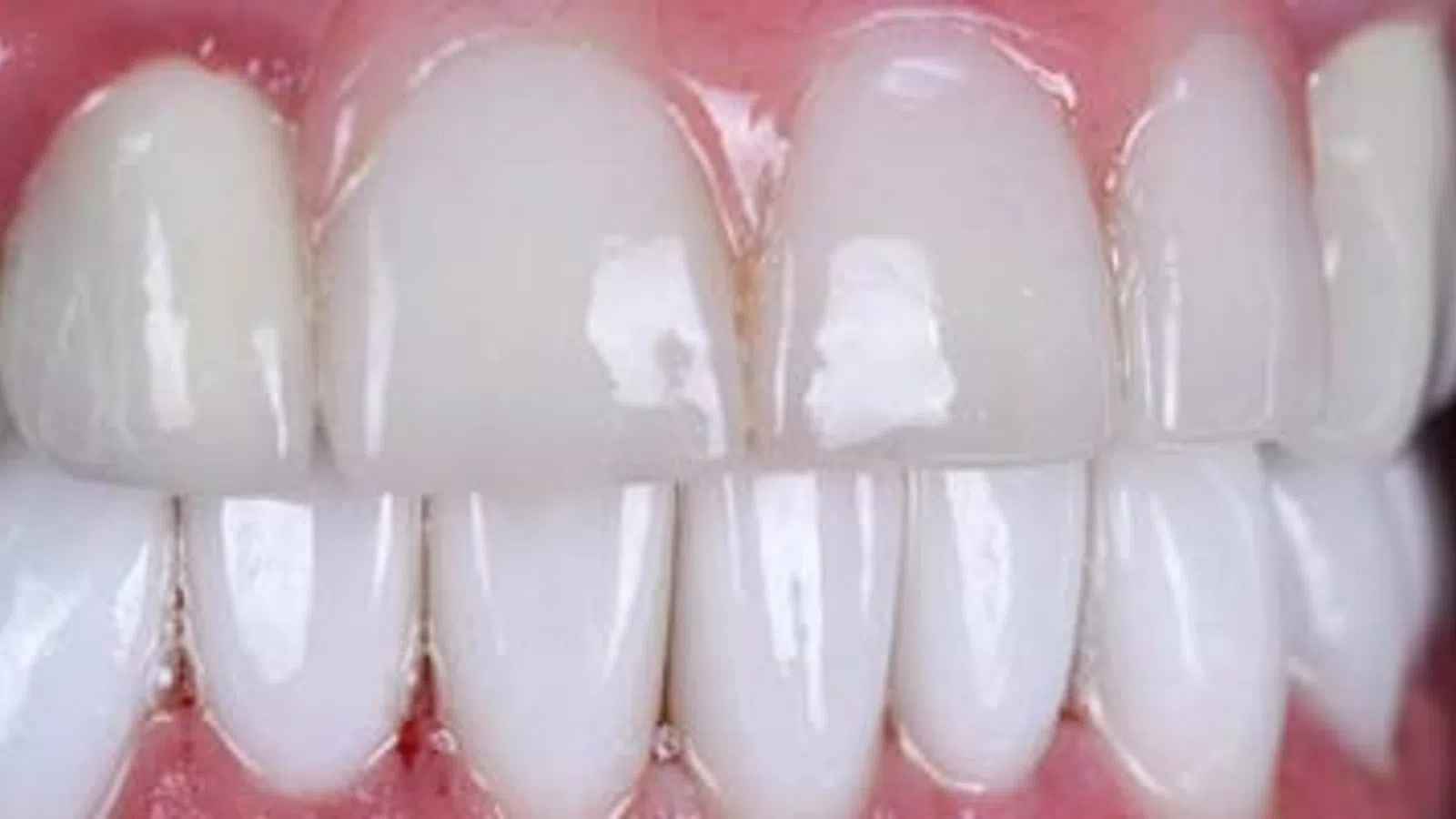 Close-up of clean, white upper and lower front teeth with healthy pink gums and shiny enamel.