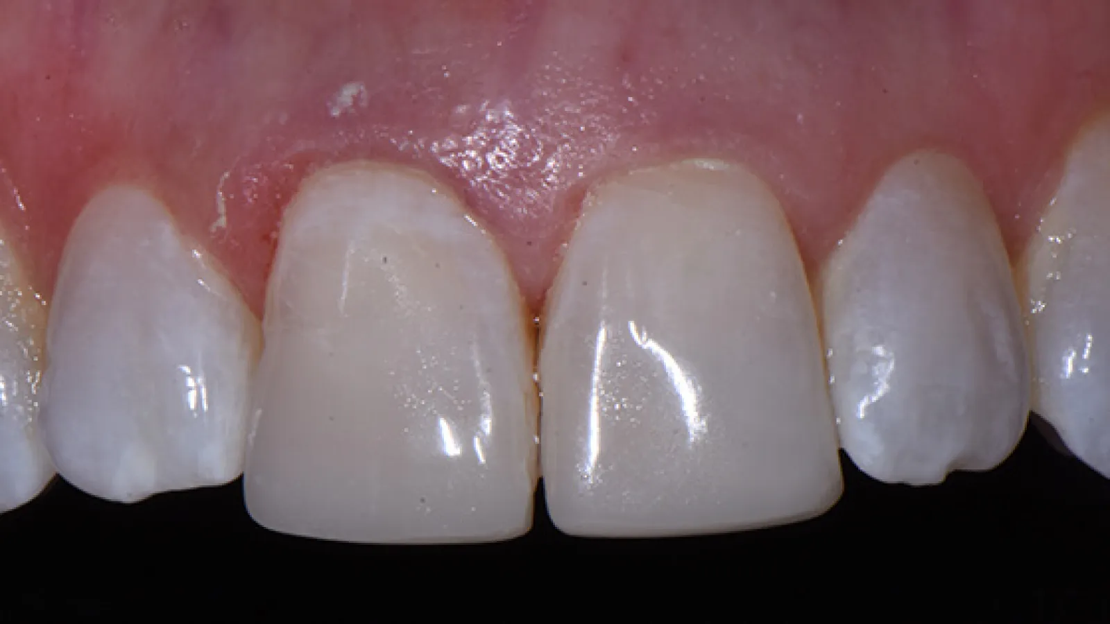 Close-up of upper front teeth and gums showing natural tooth texture and coloration.