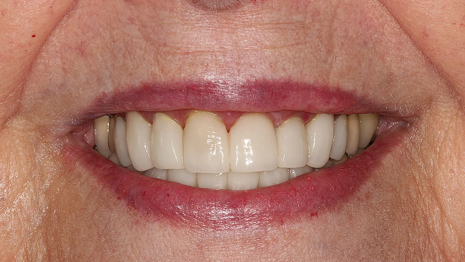 Close-up of a smiling mouth showing clean, white teeth with lips and skin texture visible