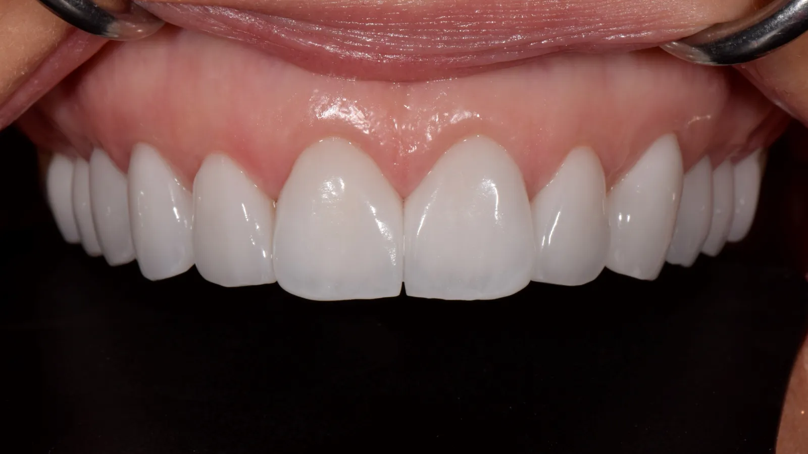 Close-up of well-aligned, clean, and bright upper front teeth with healthy gums and dental retractors.