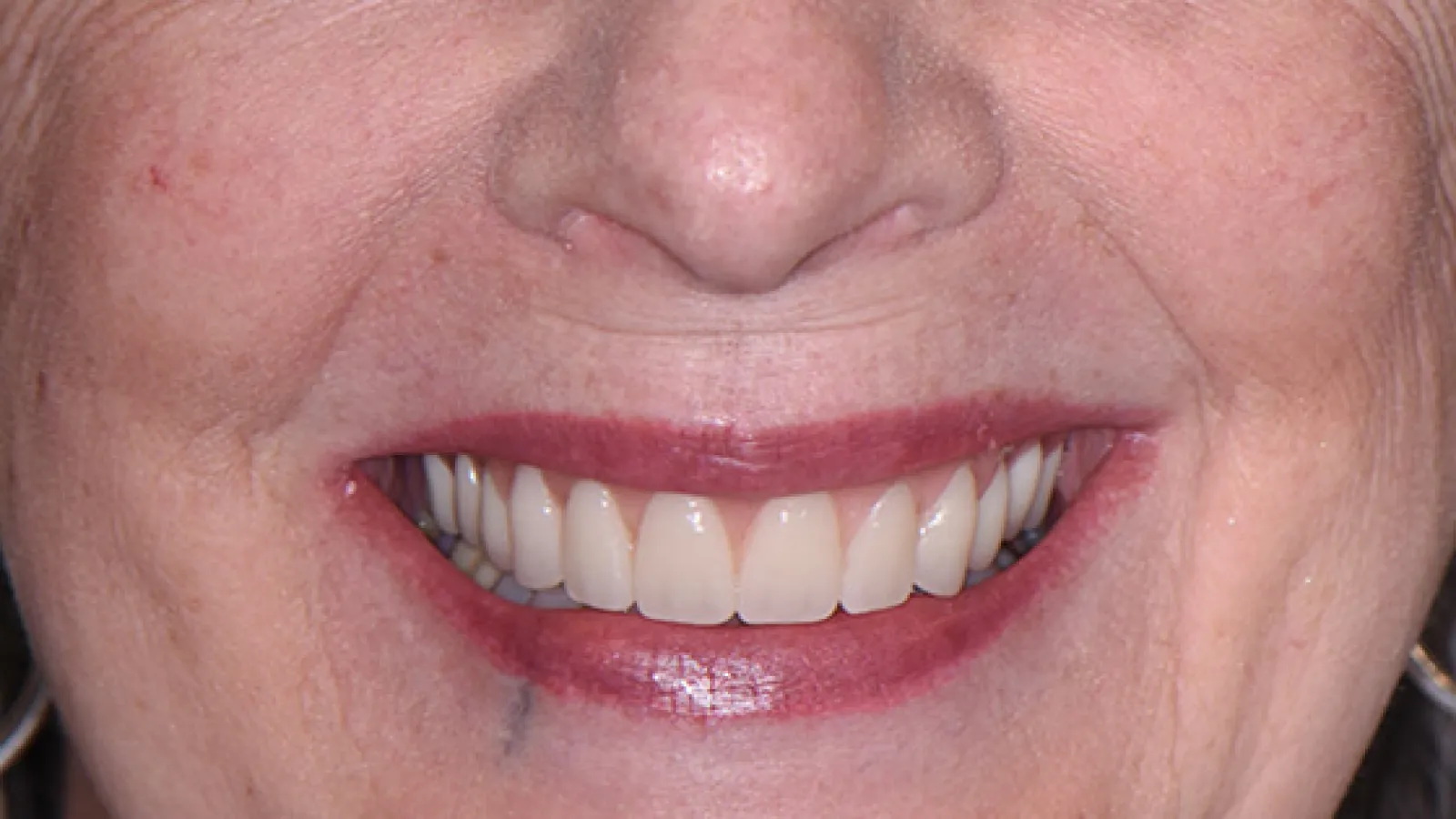 Close-up of a smiling person's mouth showing straight, white teeth and natural lip color.