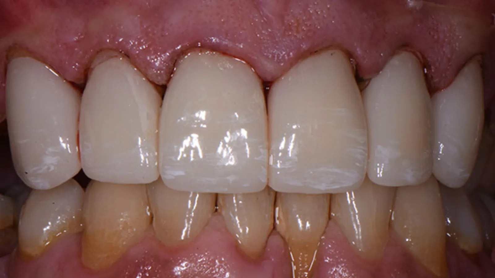 Close-up of upper and lower teeth showing dental crowns and natural teeth with gum tissue visible.