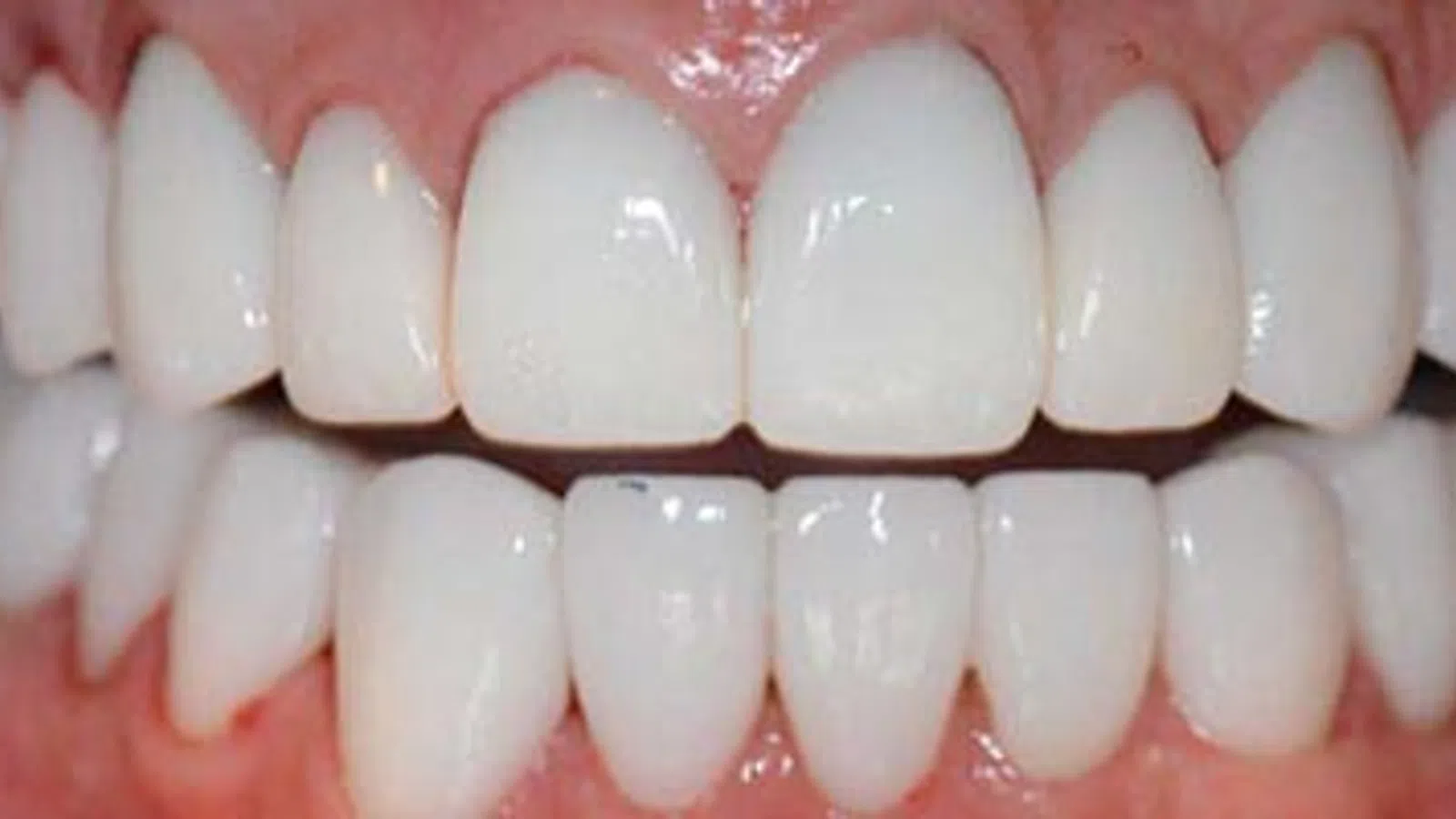Close-up of a healthy smile showing clean, white teeth with no visible staining or damage on gums.