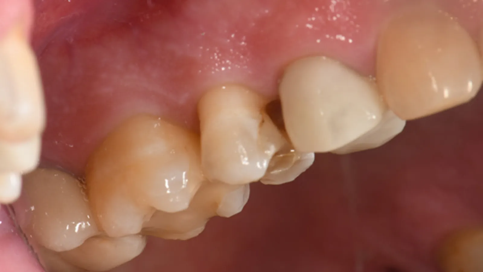 Close-up of molar teeth showing dental decay and cavity in the lower jaw