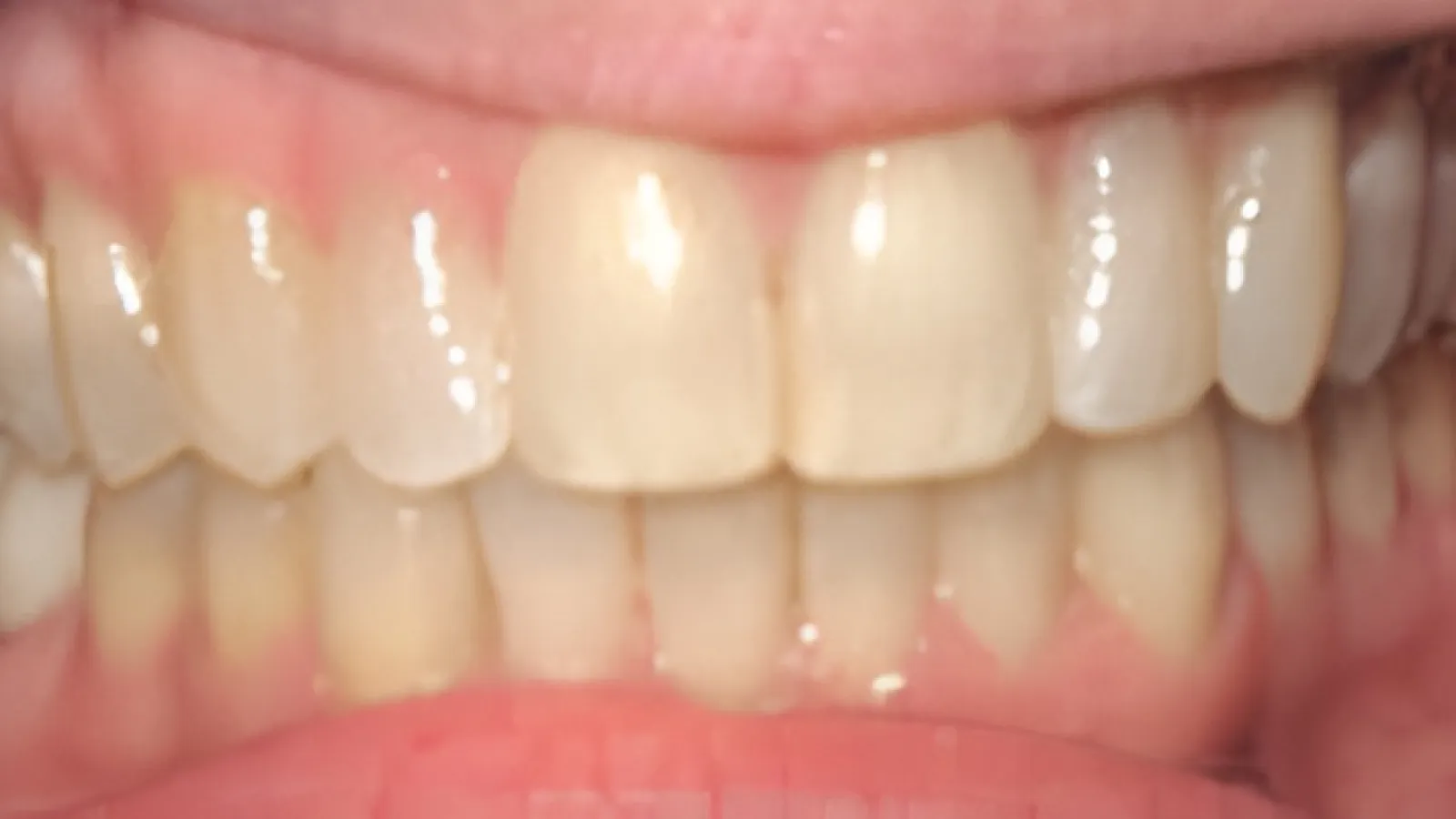 Close-up of natural teeth showing slight discoloration and healthy gums in a neutral smile.