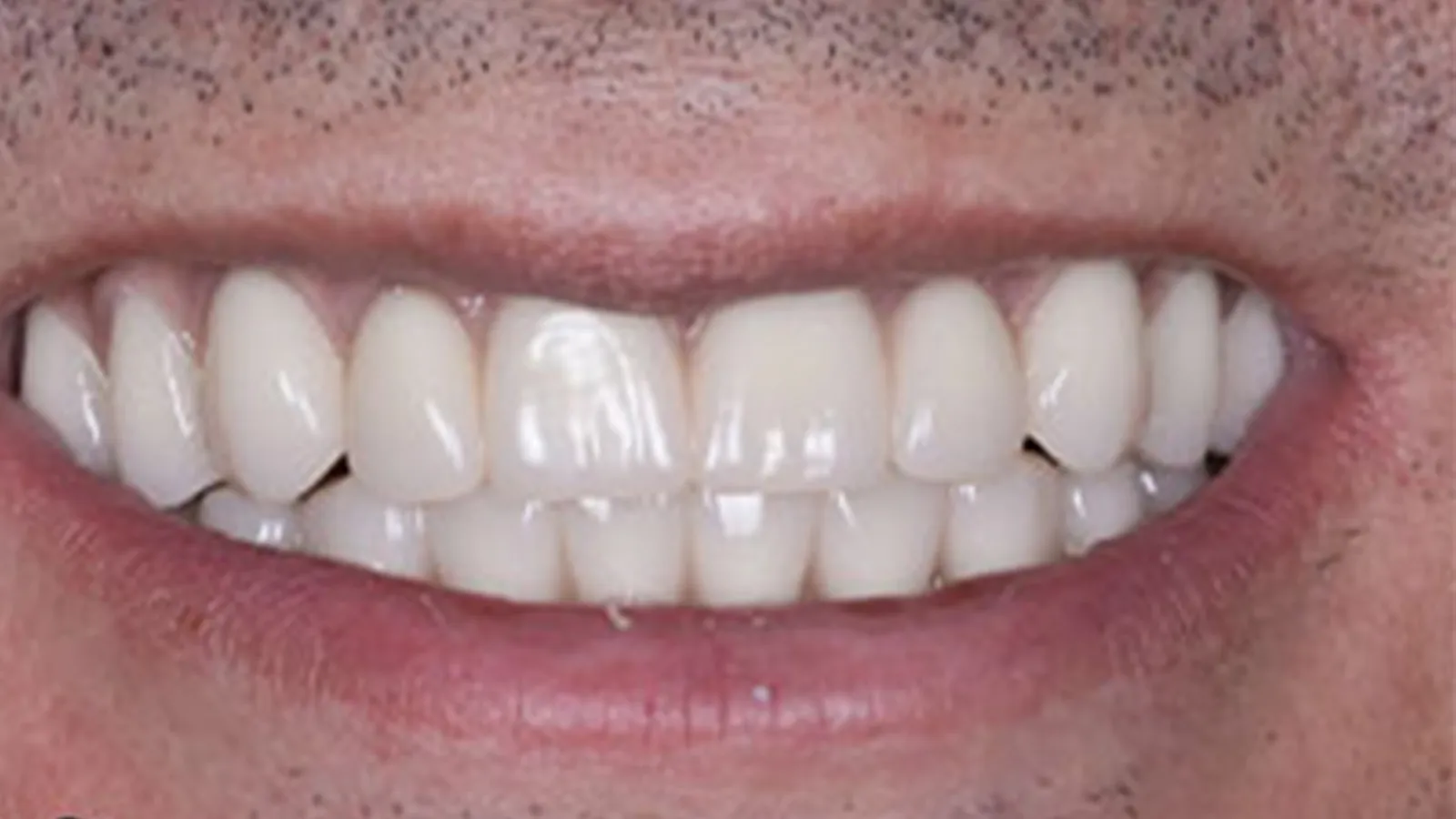 Close-up of a smiling mouth with clean white teeth and slightly visible facial hair.