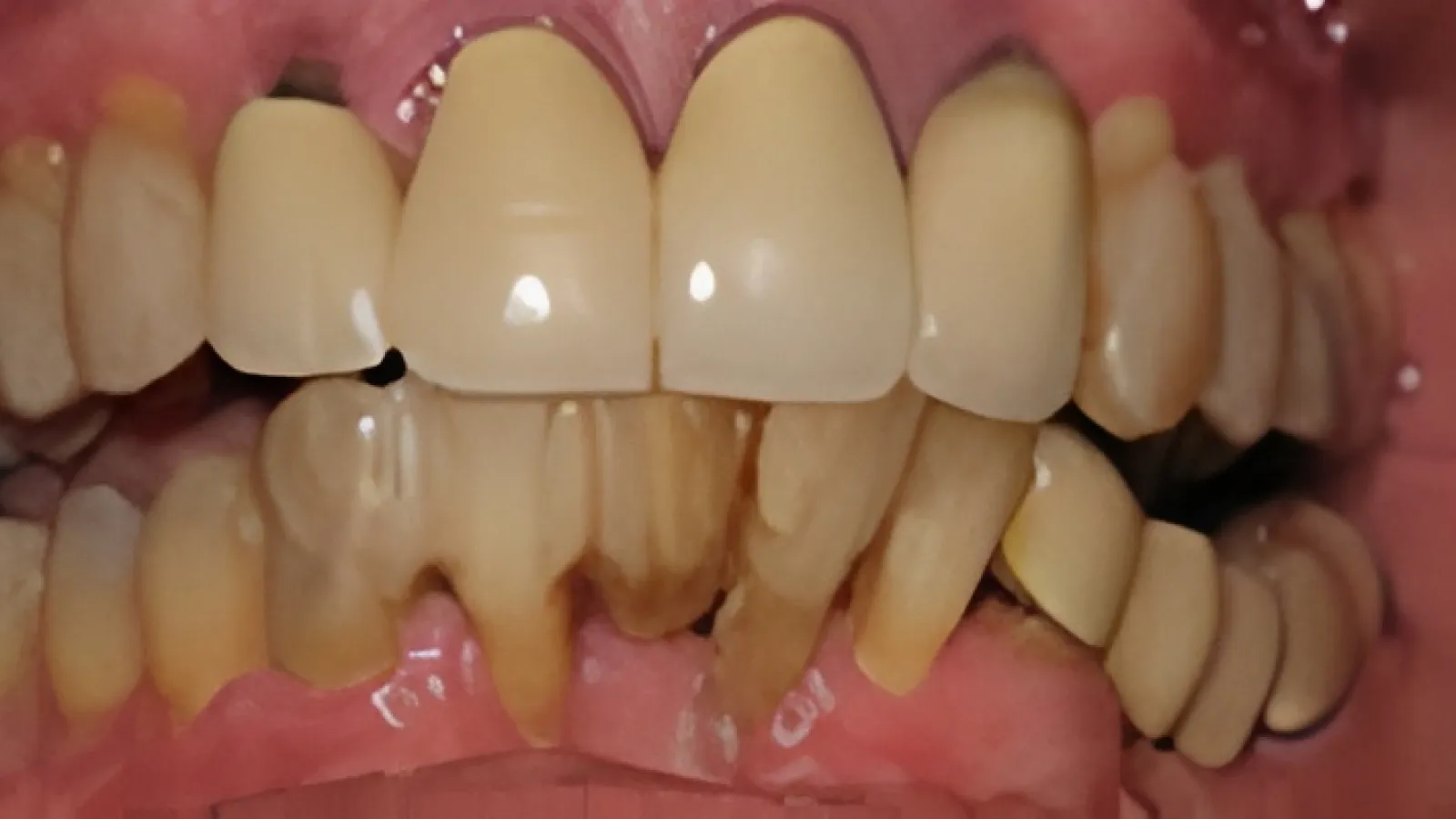 Close-up of severely damaged, discolored, and misaligned human teeth with broken and missing parts.