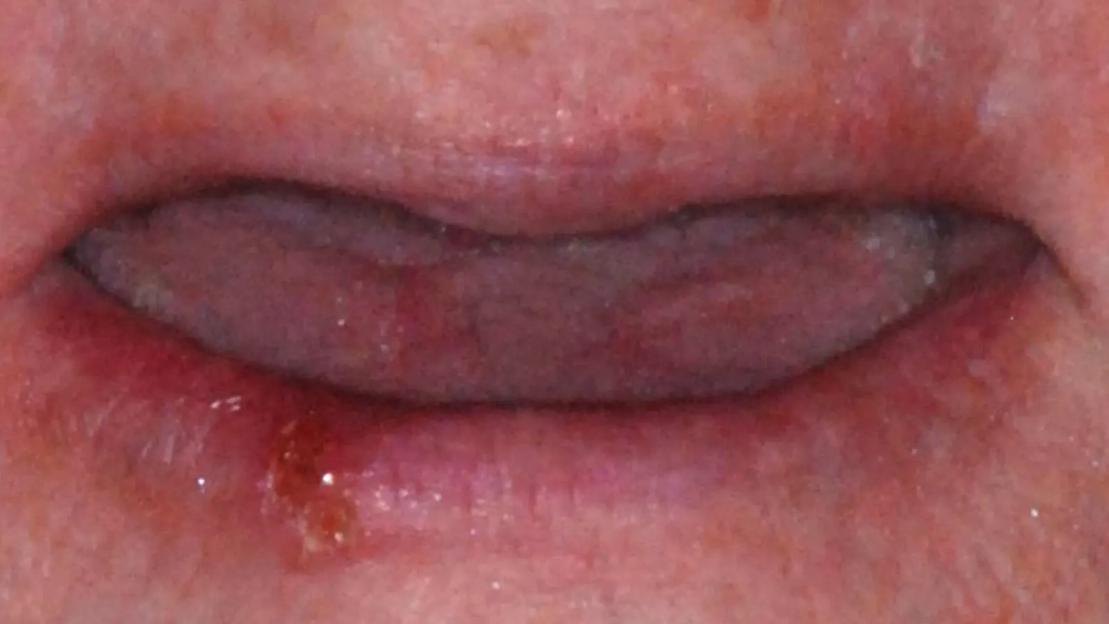 Close-up of human lips showing a cold sore on the lower lip with surrounding redness and irritation.