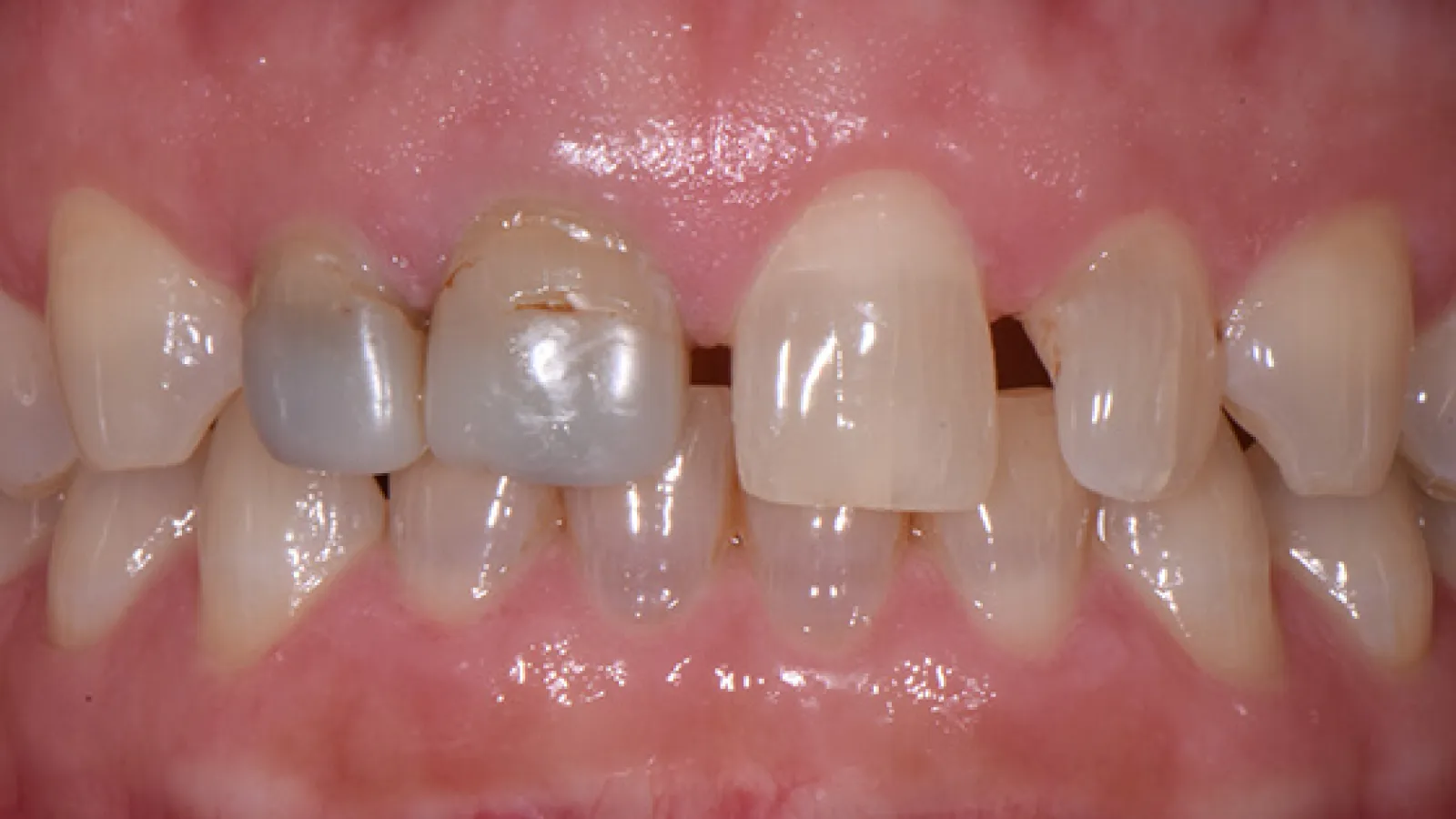 Close-up of front teeth showing discoloration, decay, and dental damage on upper incisors.