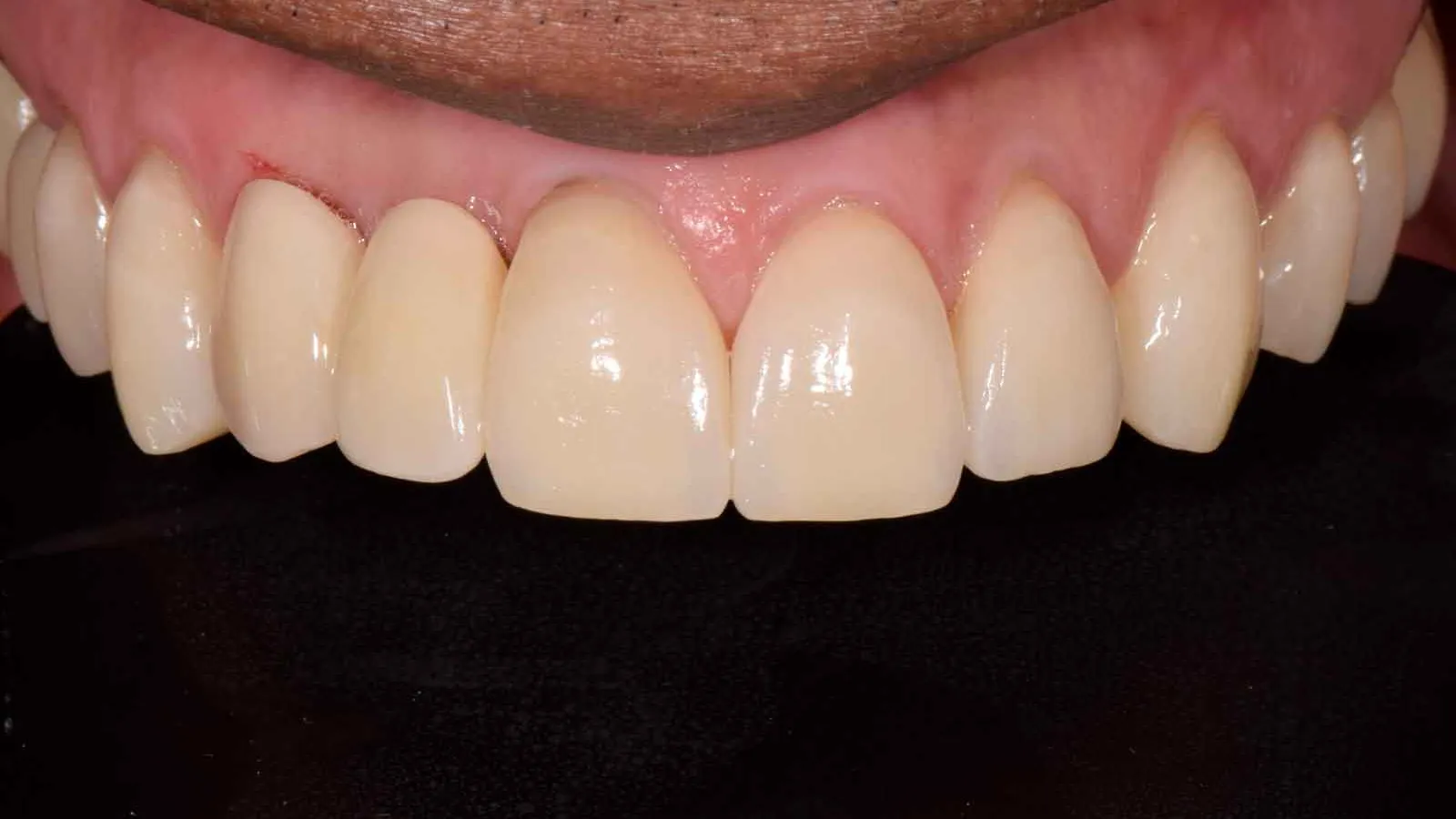Close-up of a healthy smile showing natural upper front teeth and pink gums against a black background