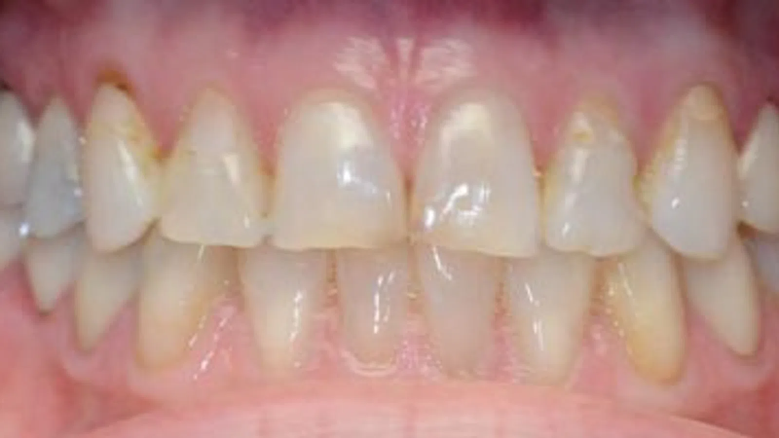 Close-up of human teeth showing yellowing and plaque buildup on upper and lower front teeth.