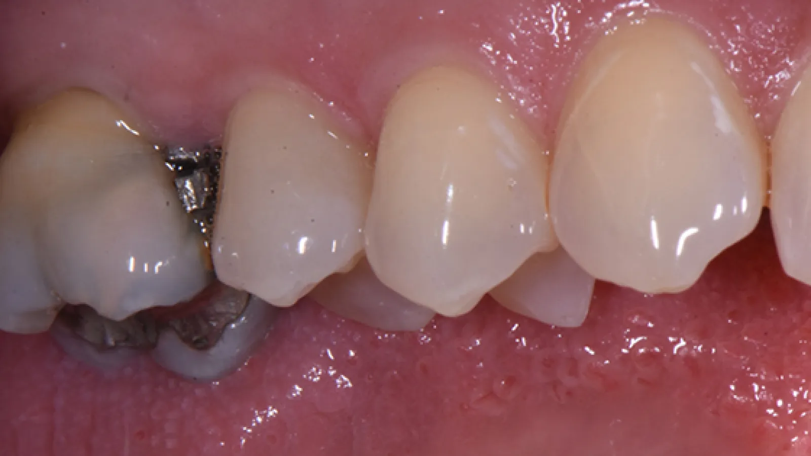 Close-up of human teeth showing dental filling and natural enamel with healthy gums.
