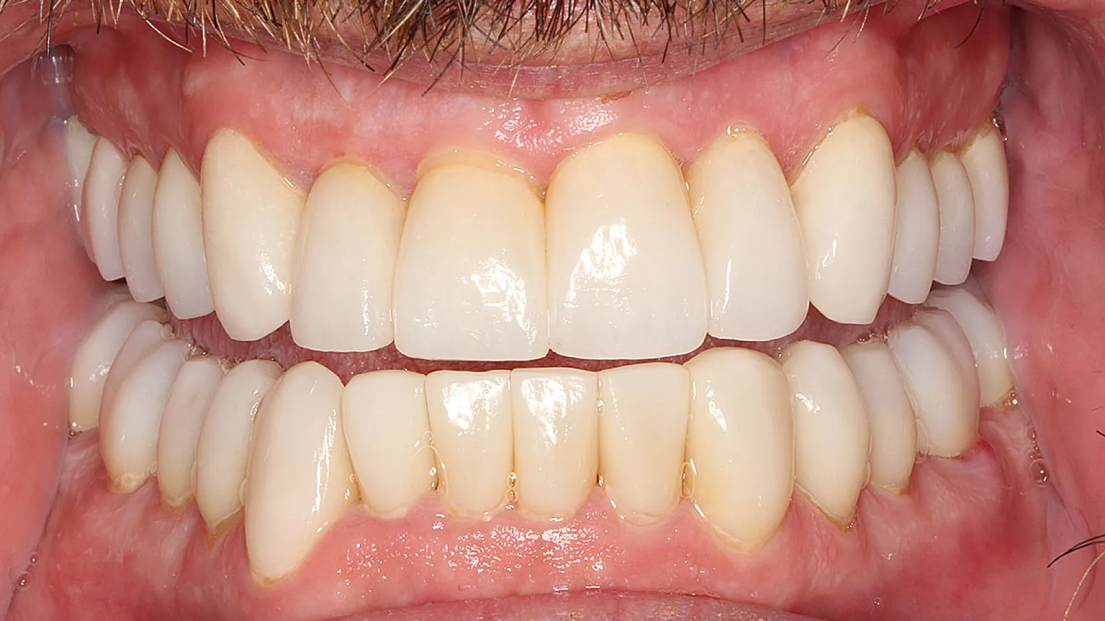 Close-up of a smiling mouth showing well-aligned clean upper and lower teeth with natural gums visible.