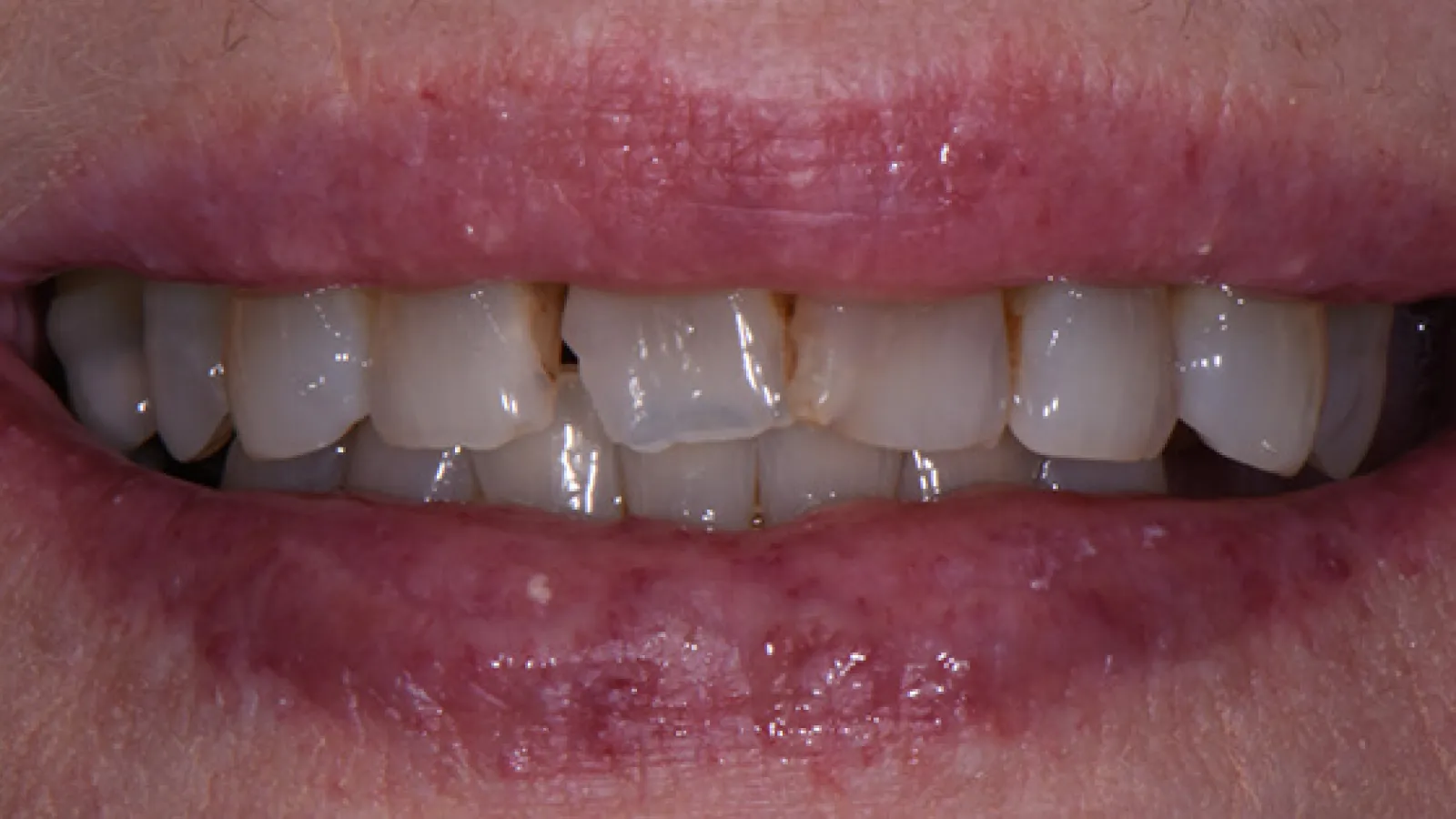 Close-up of a mouth showing chipped and stained upper front teeth with dry, cracked lips.
