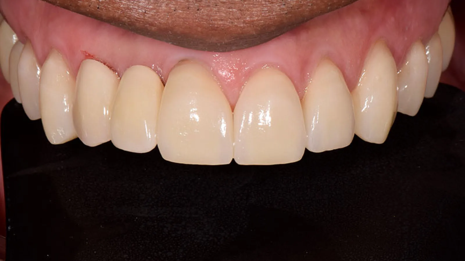 Close-up of a person's upper front teeth with natural gums against a black background.