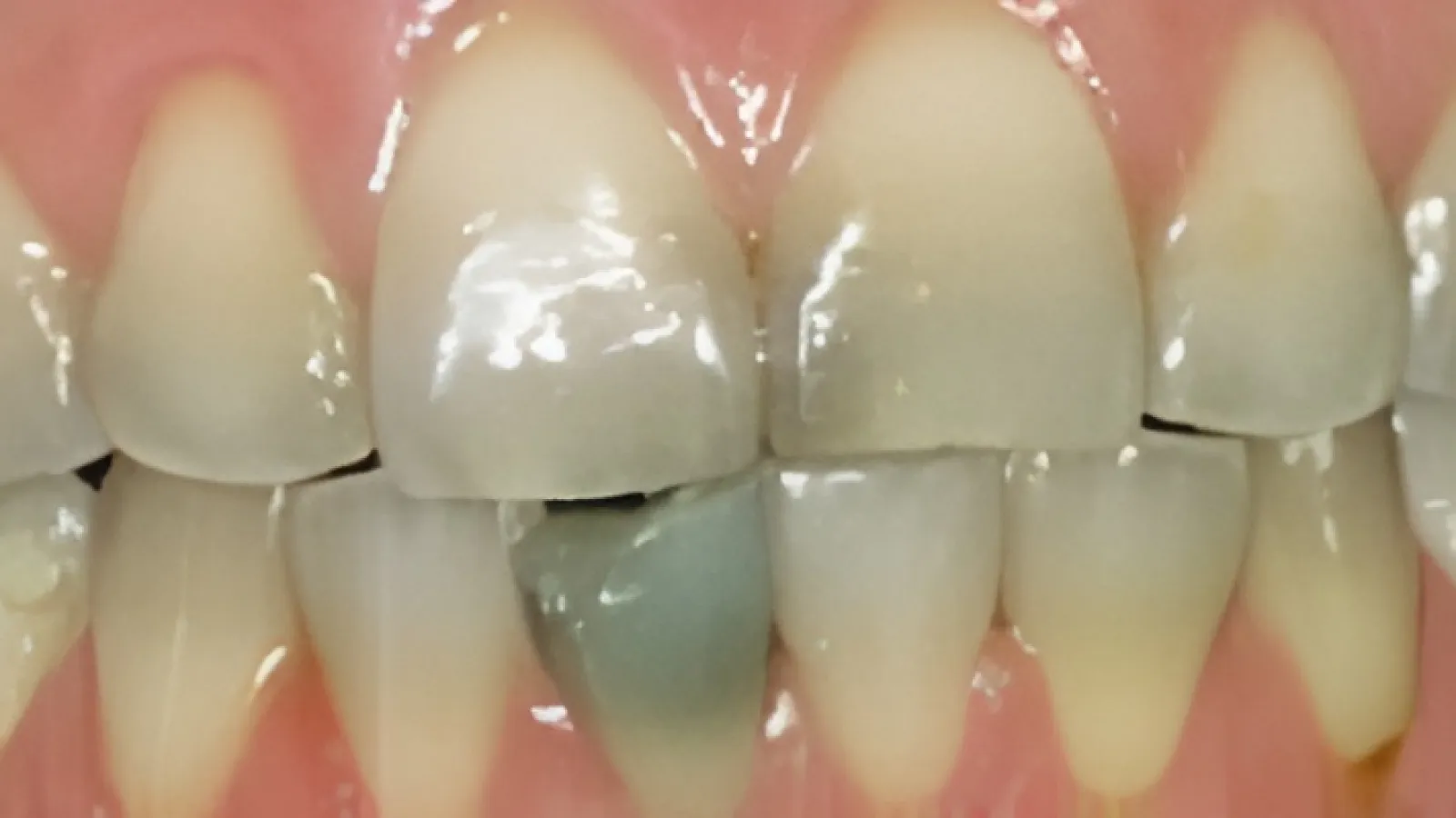Close-up of teeth showing a discolored gray tooth among healthy white teeth and pink gums