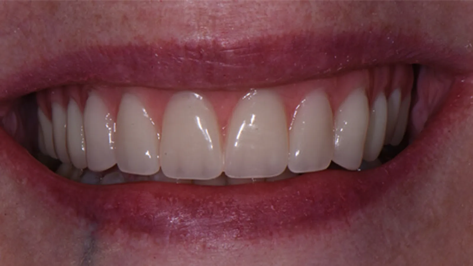 Close-up of a smiling mouth showing clean, straight, white teeth and healthy pink gums.