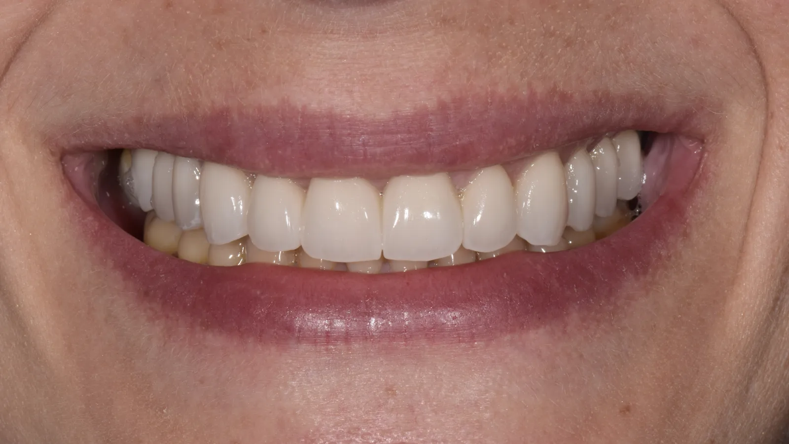 Close-up of a smiling mouth showing clean, white, evenly aligned teeth and healthy lips.
