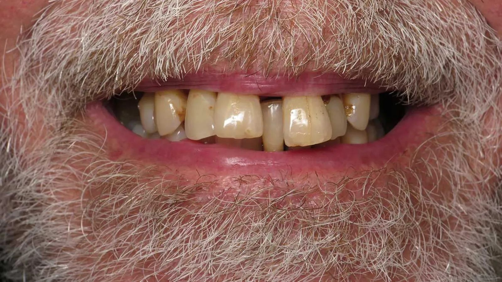 Close-up of an elderly man's mouth showing stained, crooked teeth and grey facial hair.