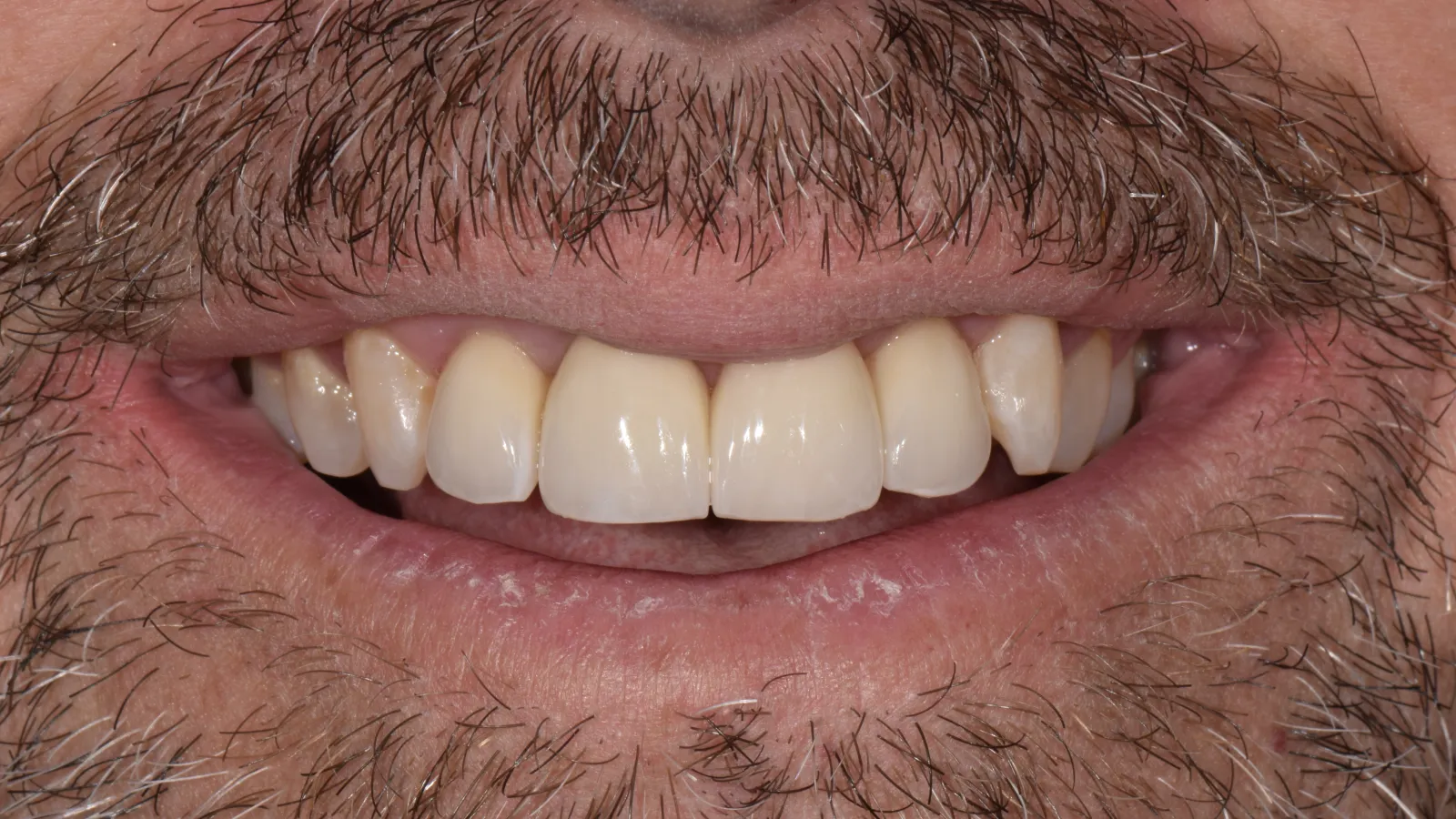 Close-up of a smiling man's mouth showing natural teeth and a mustache with gray and brown hair
