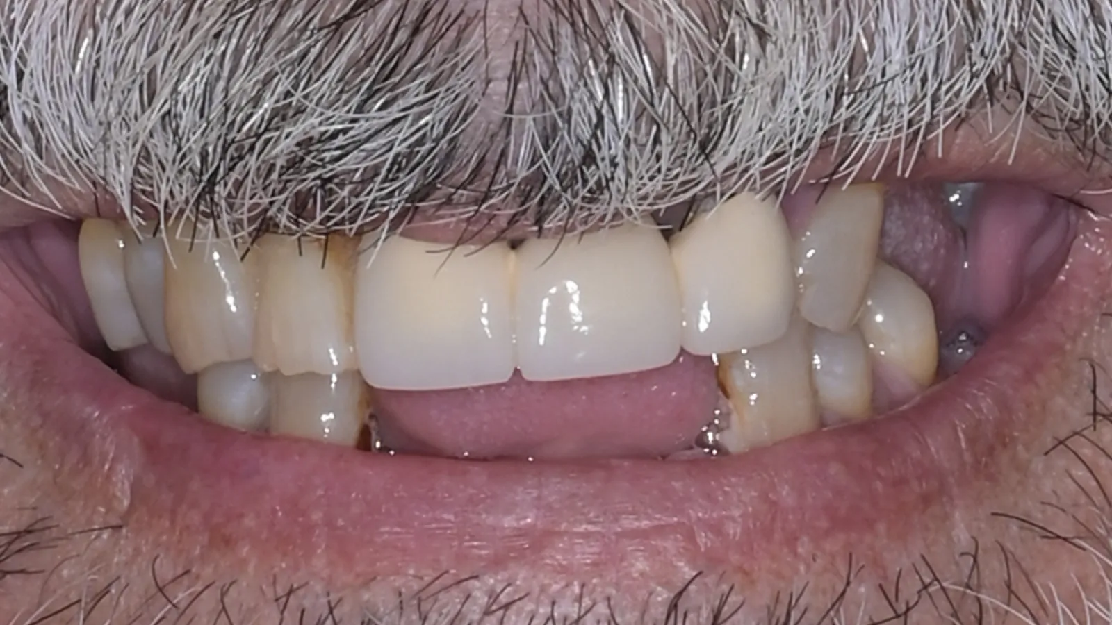 Close-up of a smiling mouth showing teeth with dental crowns and natural teeth with grey facial hair.