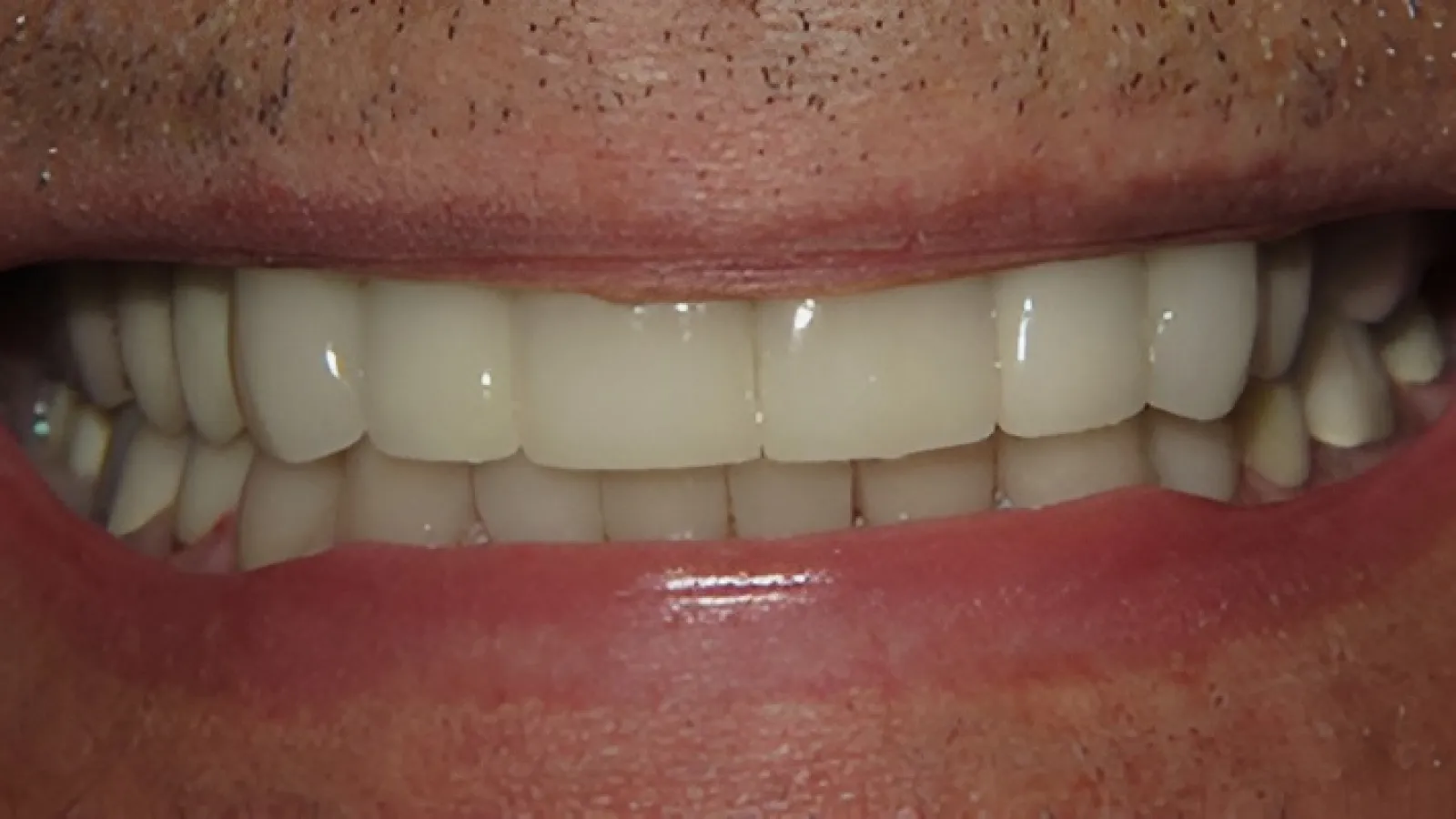 Close-up of a smiling mouth showing teeth and lips with natural skin texture and light facial hair.