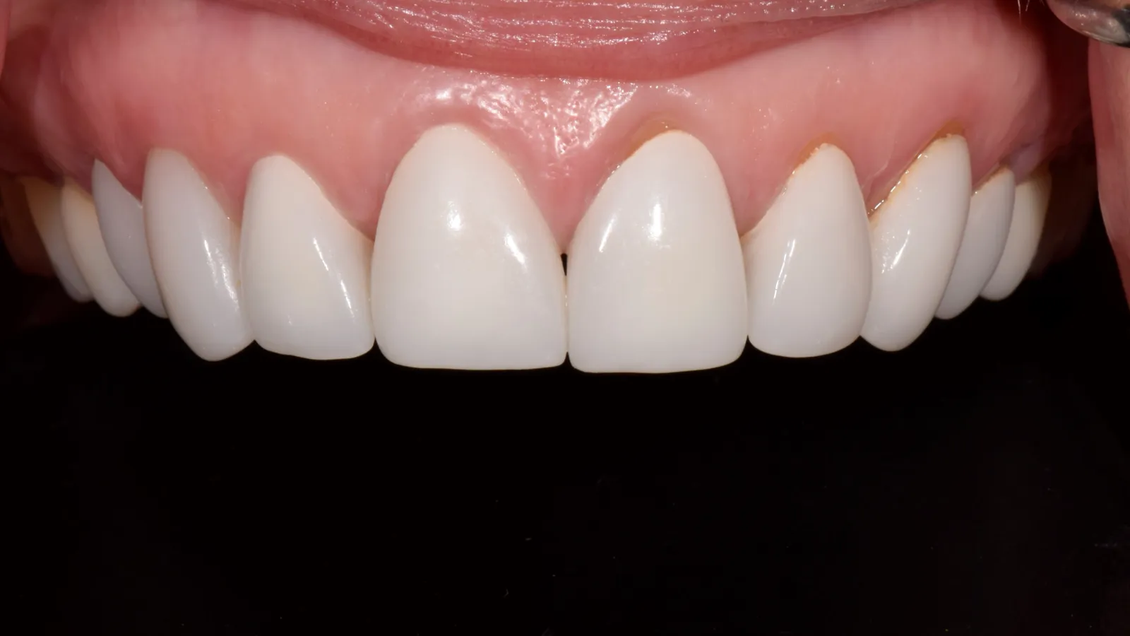 Close-up of upper front teeth with dental veneers or crowns against a black background.