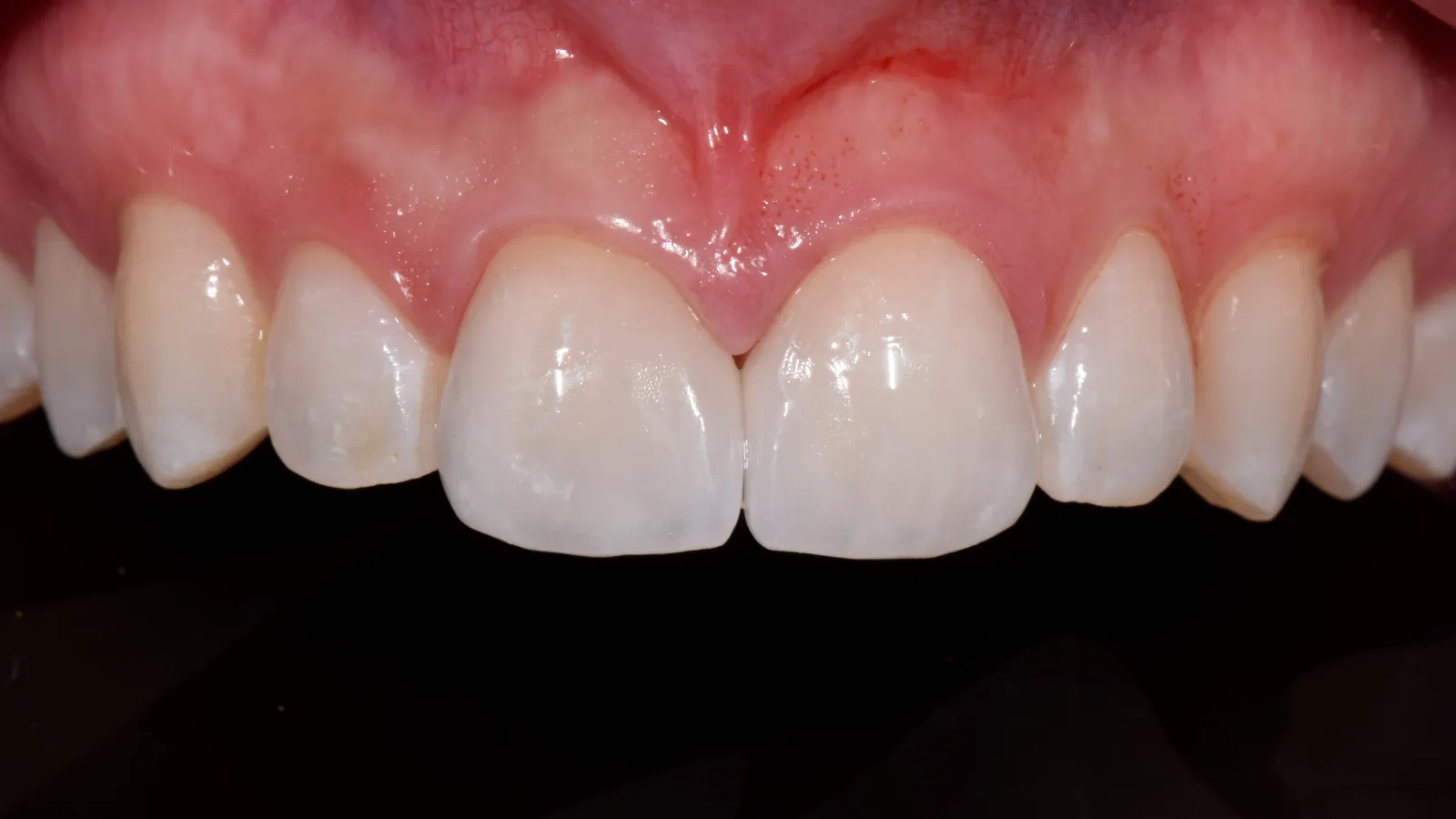 Close-up of upper front teeth and gums showing healthy enamel and pink gum tissue against black background.