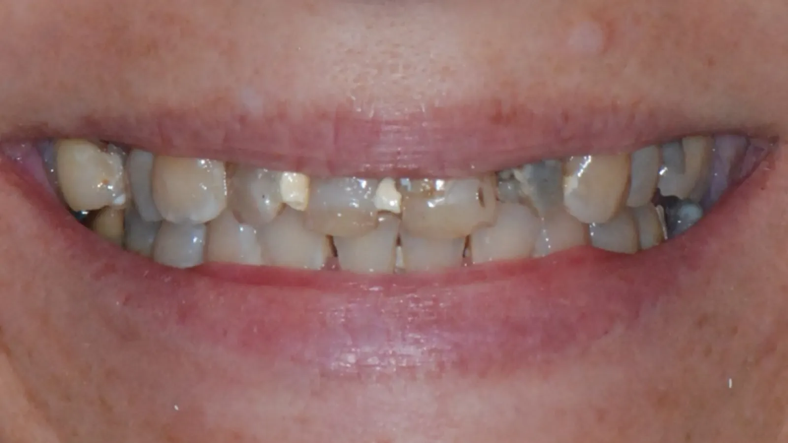 Close-up of a smile showing severely decayed, stained, and damaged teeth with visible dental plaque and cavities.