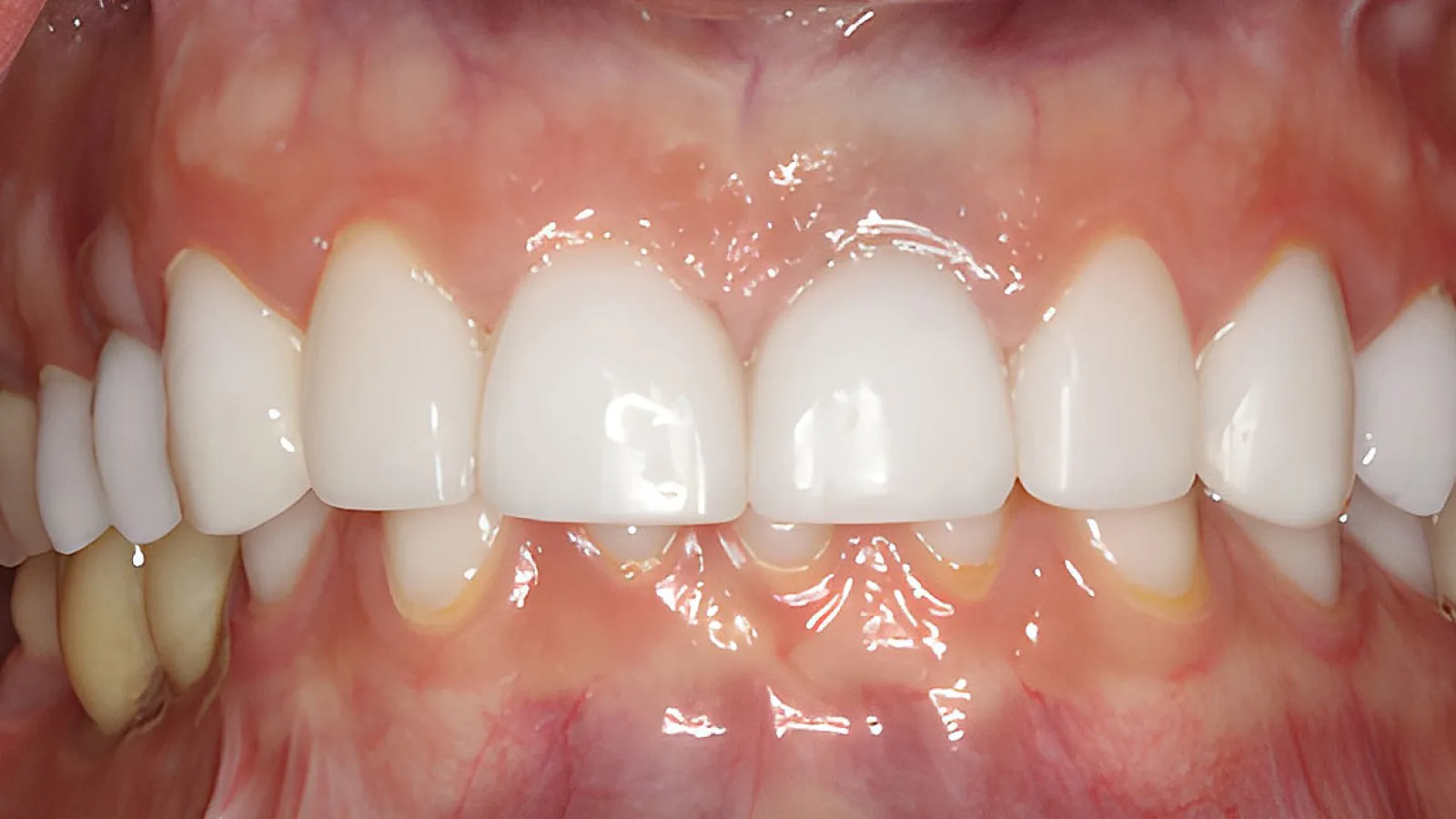 Close-up of healthy white teeth and gums showing dental alignment and natural shine under bright light.