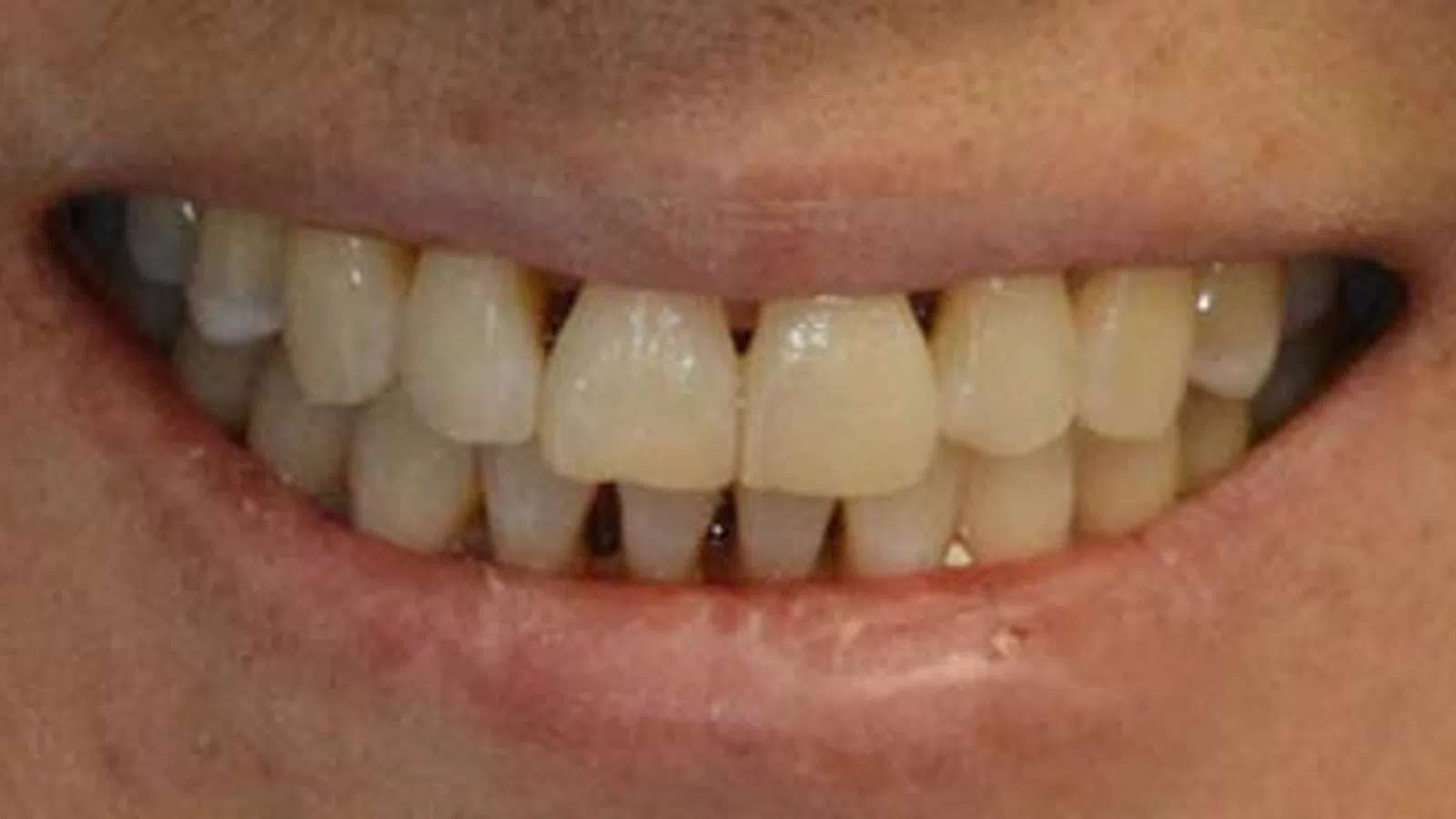 Close-up of a smiling mouth showing slightly yellow and misaligned teeth and natural lips.