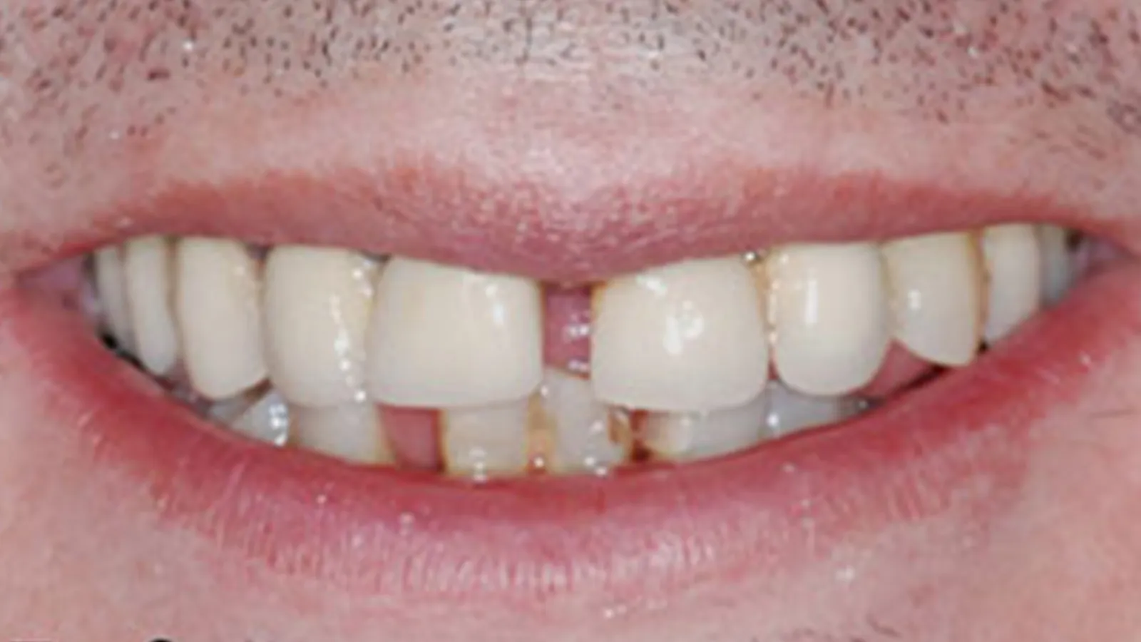 Close-up of a smiling person's mouth showing gaps and discoloration on teeth.