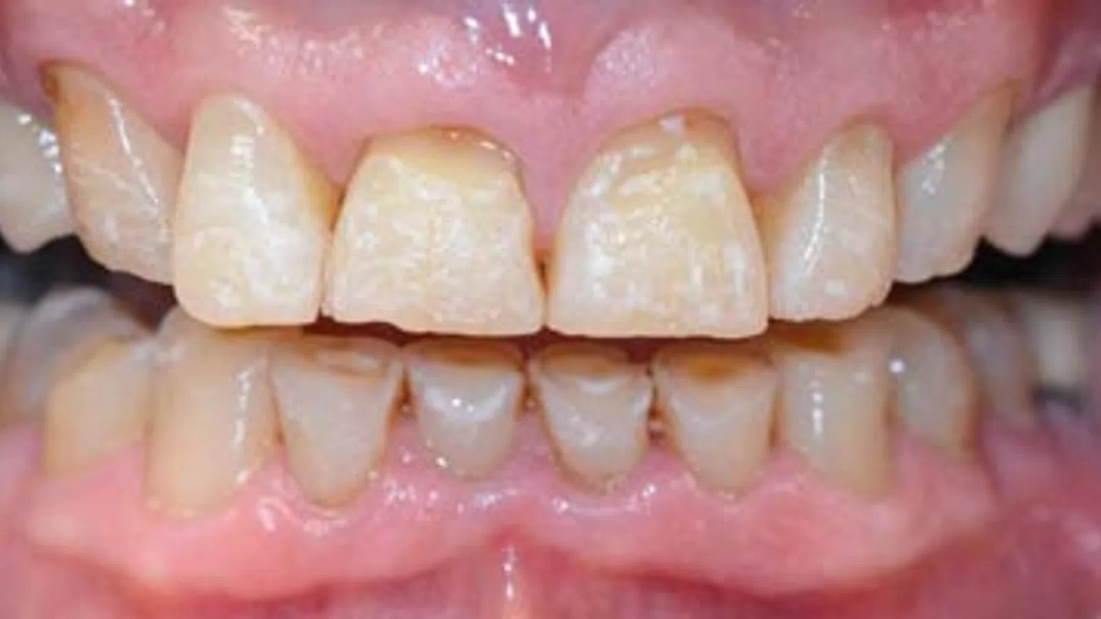 Close-up of upper and lower teeth with visible discoloration and dental plaque buildup.