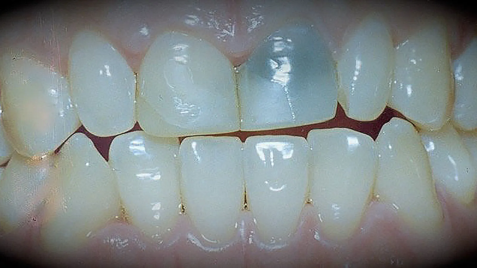 Close-up view of healthy human teeth with one discolored tooth showing signs of damage.