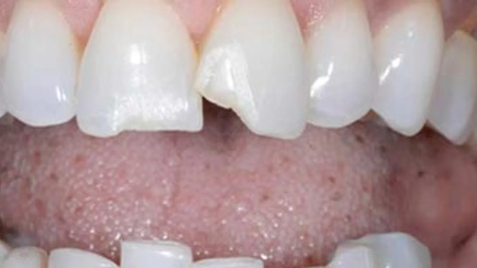Close-up of chipped front tooth with visible enamel damage on upper teeth.