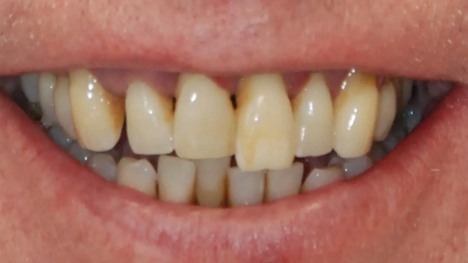 Close-up of damaged and discolored human teeth with visible gaps and uneven alignment.