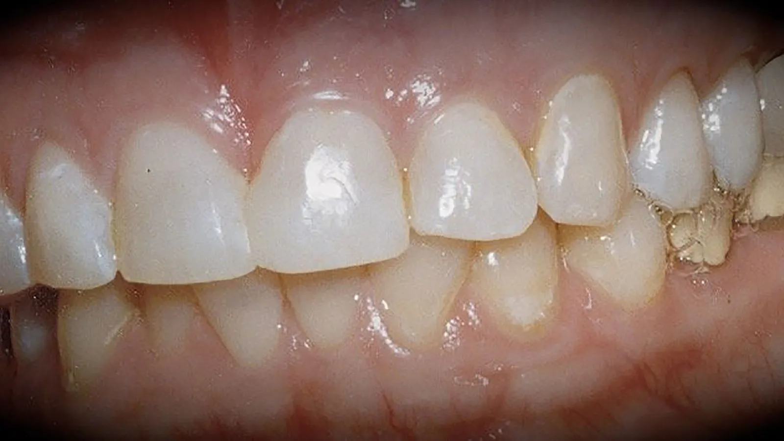 Close-up of healthy human teeth showing enamel and gum structure in detail.