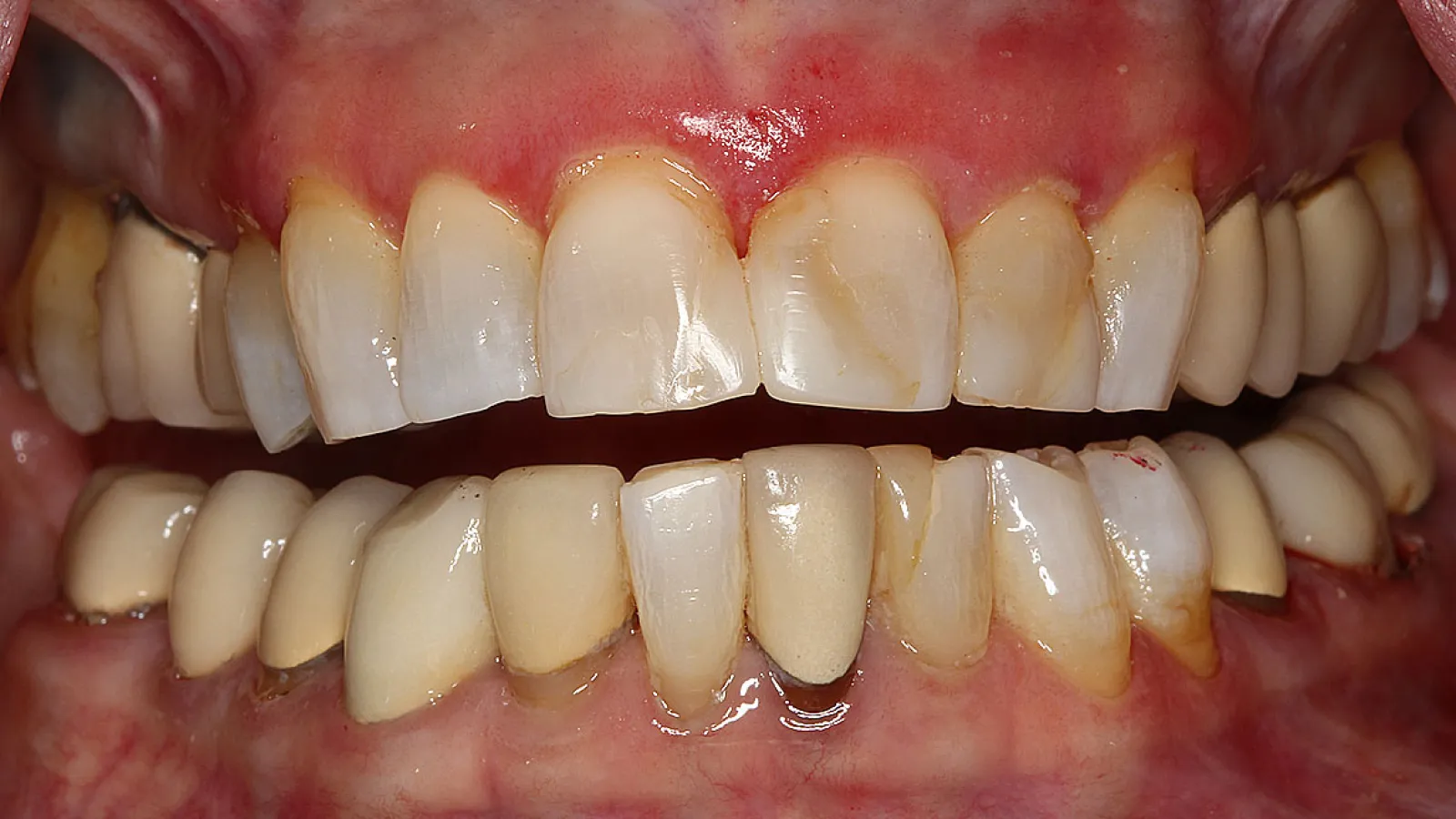 Close-up of human teeth showing dental plaque buildup and slight discoloration on upper and lower teeth.