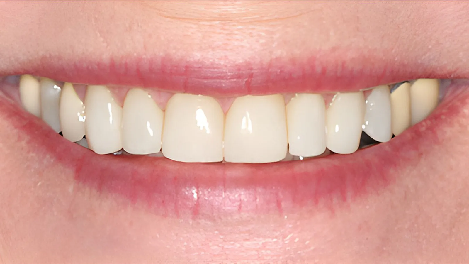 Close-up of a smiling mouth showing clean, white teeth and healthy pink lips.
