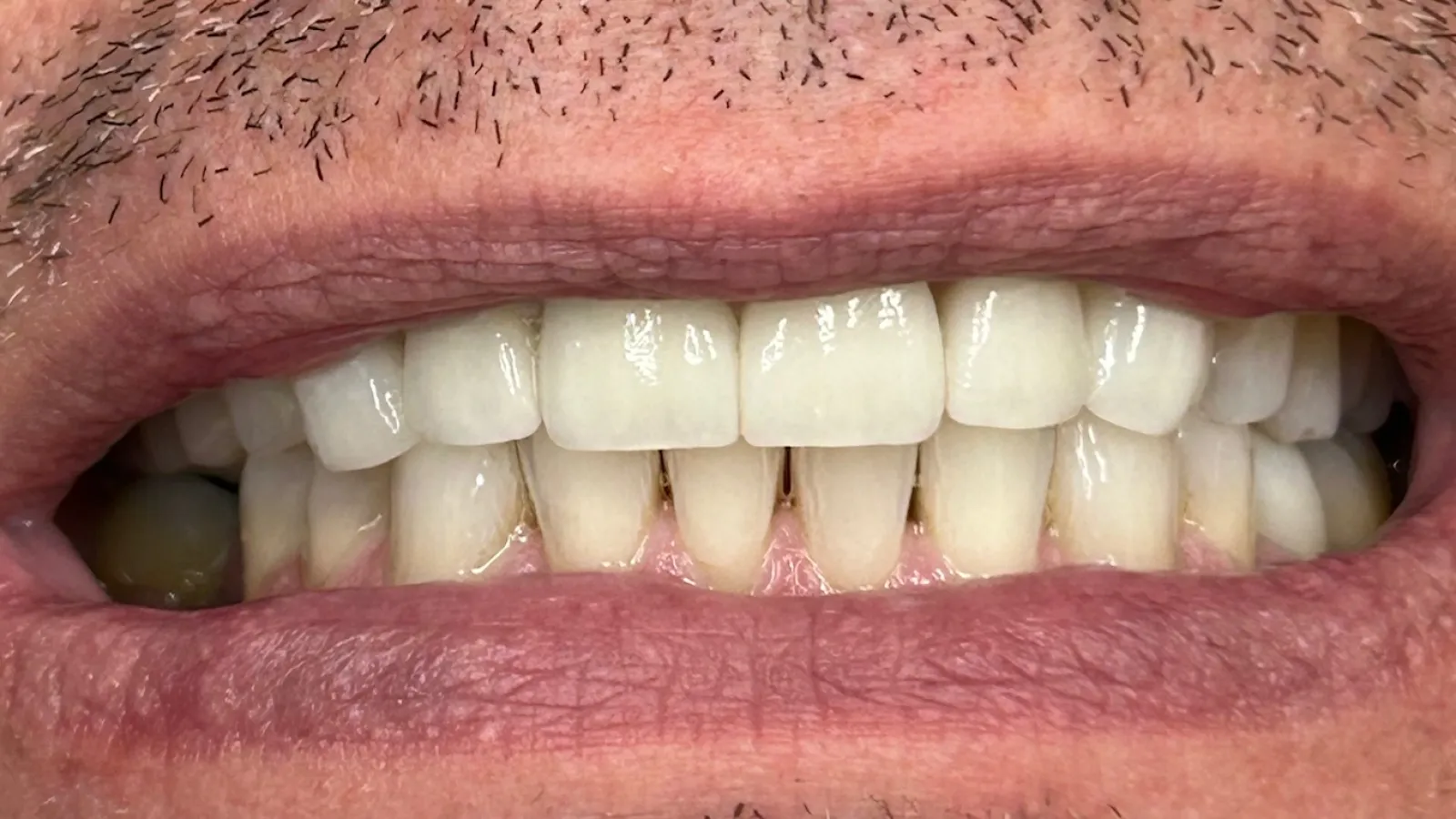 Close-up of a man's mouth showing natural teeth with some facial hair stubble above the lip.