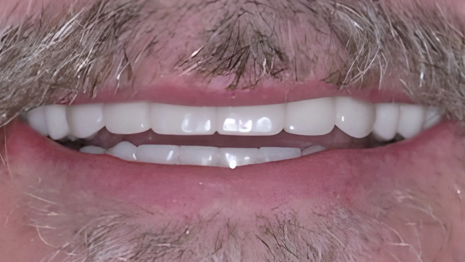 Close-up of a smiling mouth with clean white teeth and facial hair around the lips and chin.