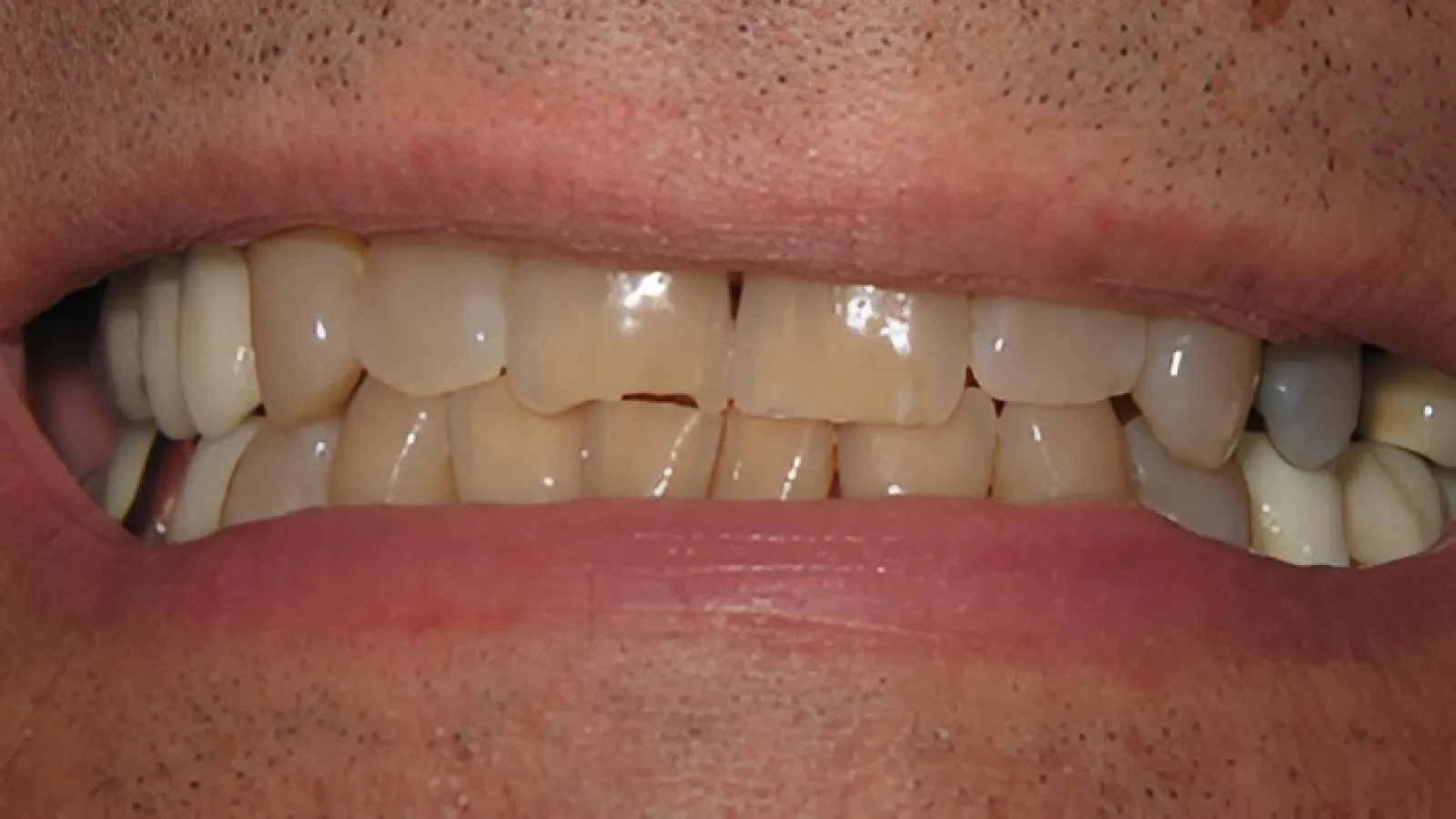 Close-up of stained and cracked teeth with discolored enamel and visible dental damage in a human mouth.